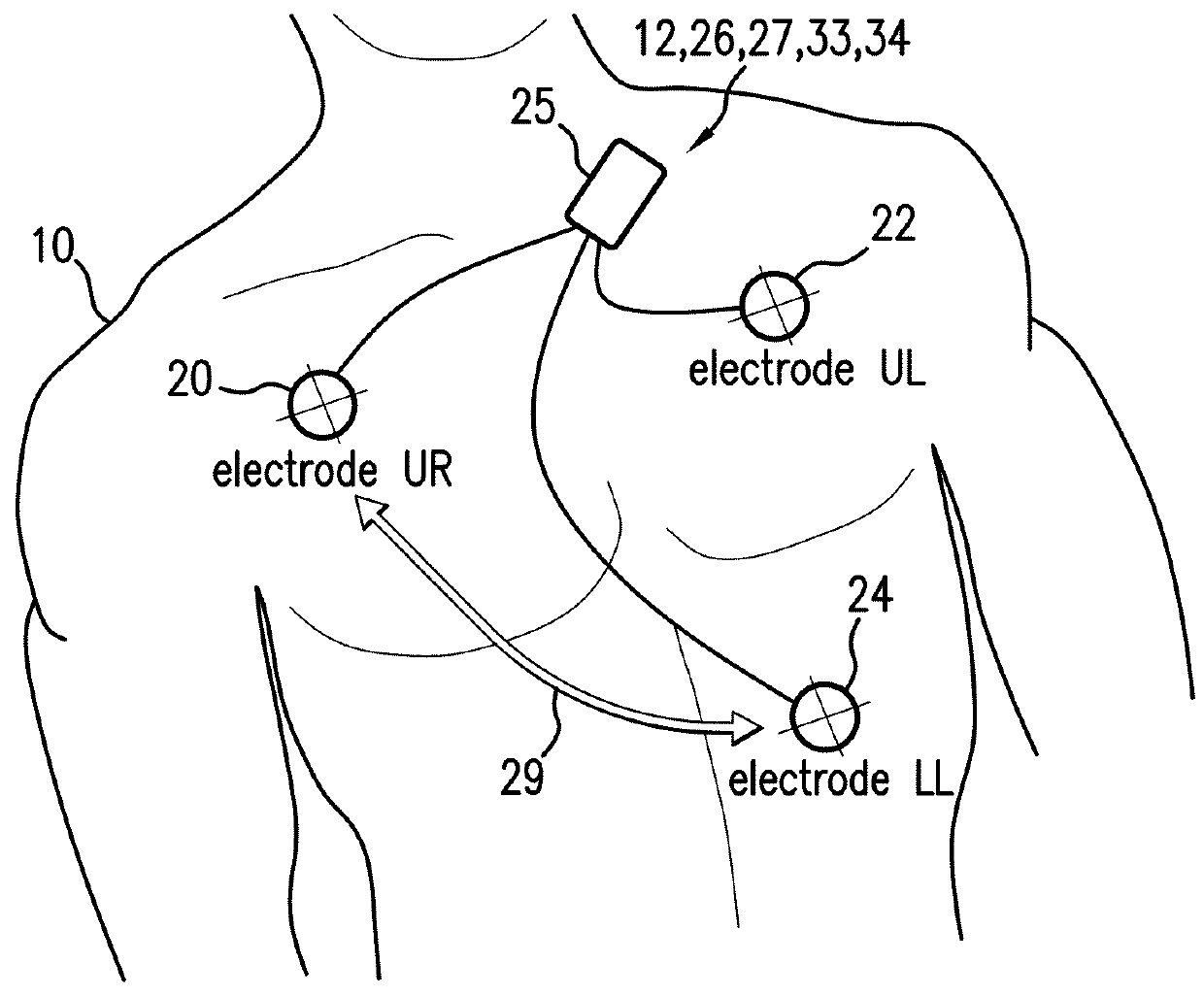 Body-worn monitor for measuring respiratory rate