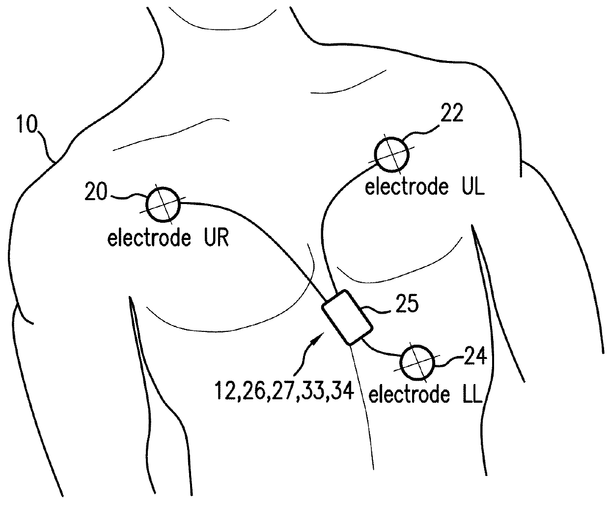 Body-worn monitor for measuring respiratory rate