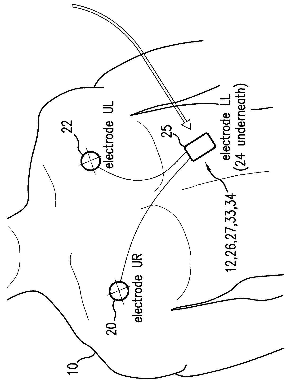 Body-worn monitor for measuring respiratory rate