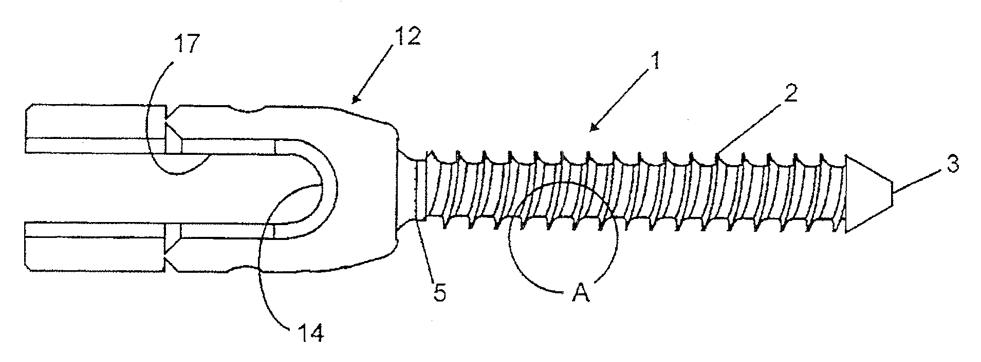 Pedicular percutaneous minimally invasive screw