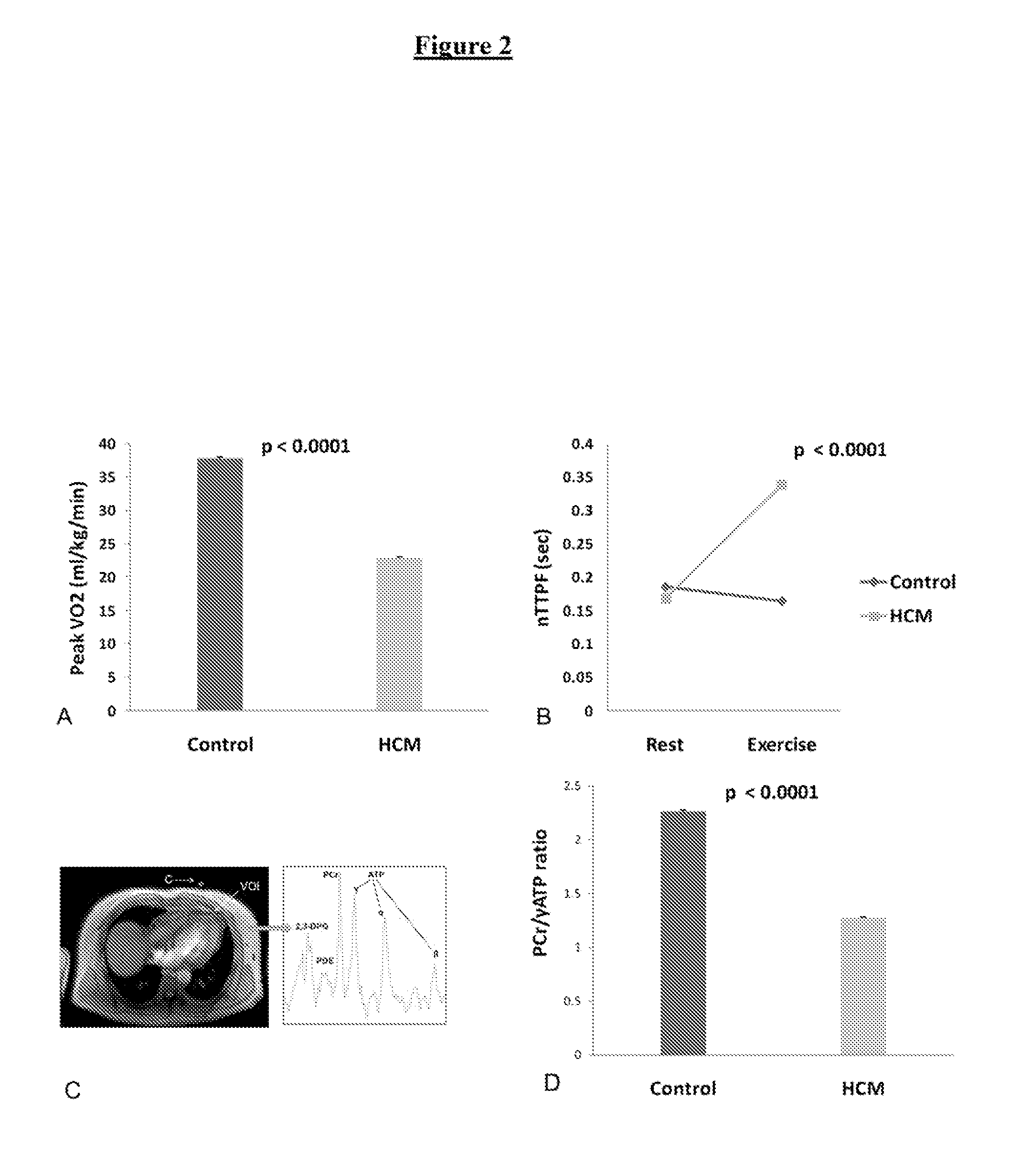 Perhexiline for use in the treatment of hypertrophic cardiomyopathy (HCM)