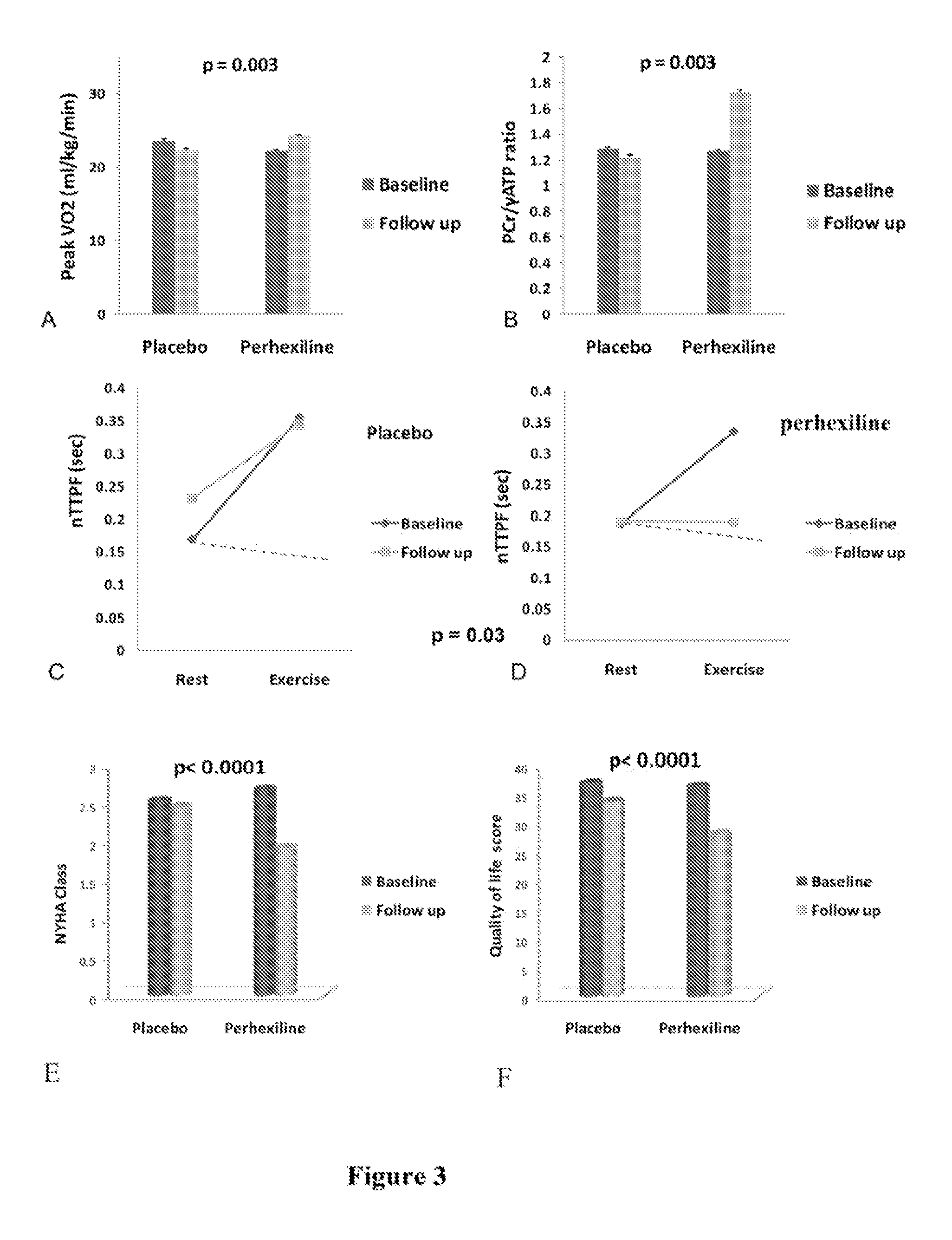 Perhexiline for use in the treatment of hypertrophic cardiomyopathy (HCM)