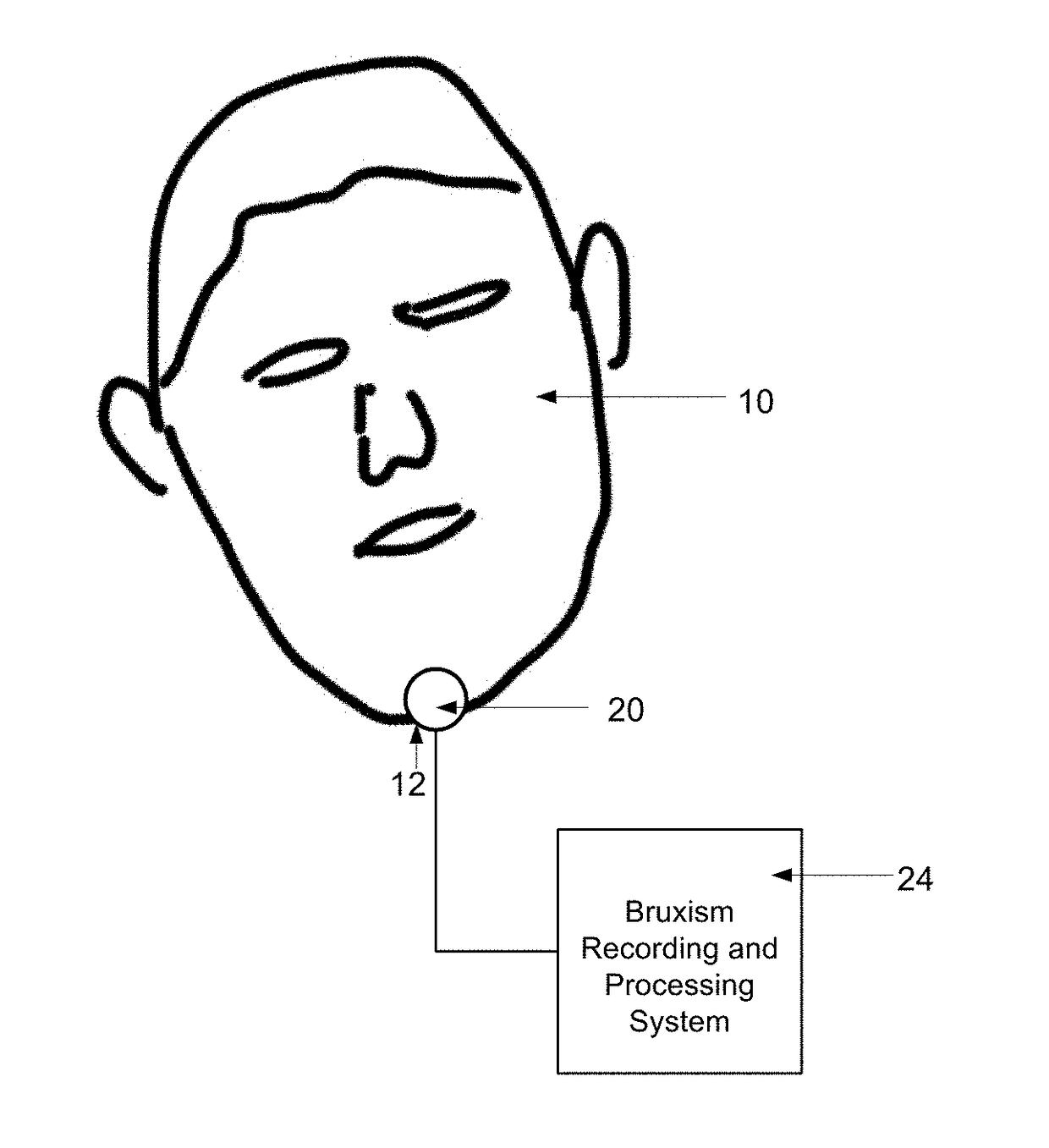 Bruxism Detection System With Chin-Mounted Accelerometer Sensor