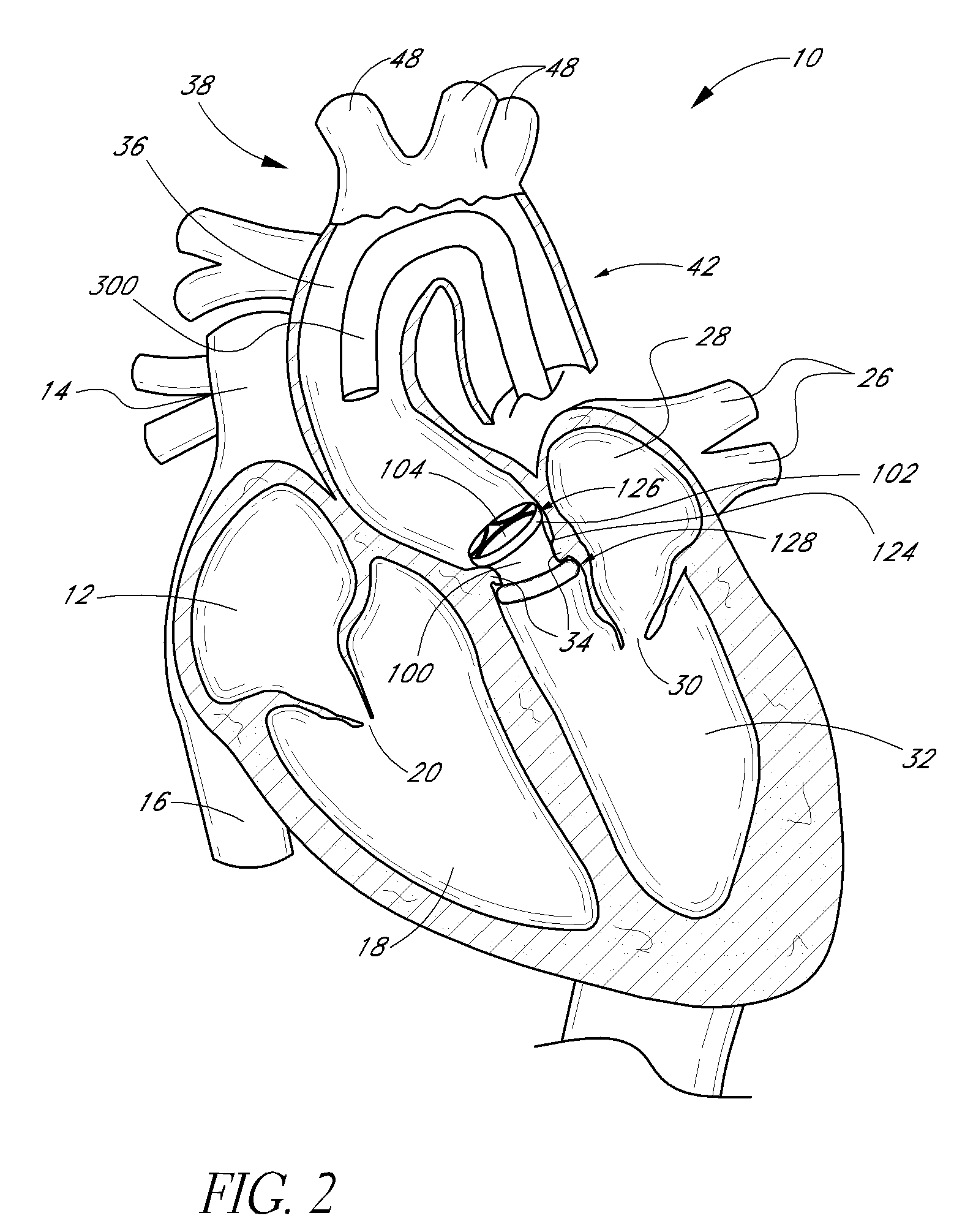 Translumenally implantable heart valve with formed in place support