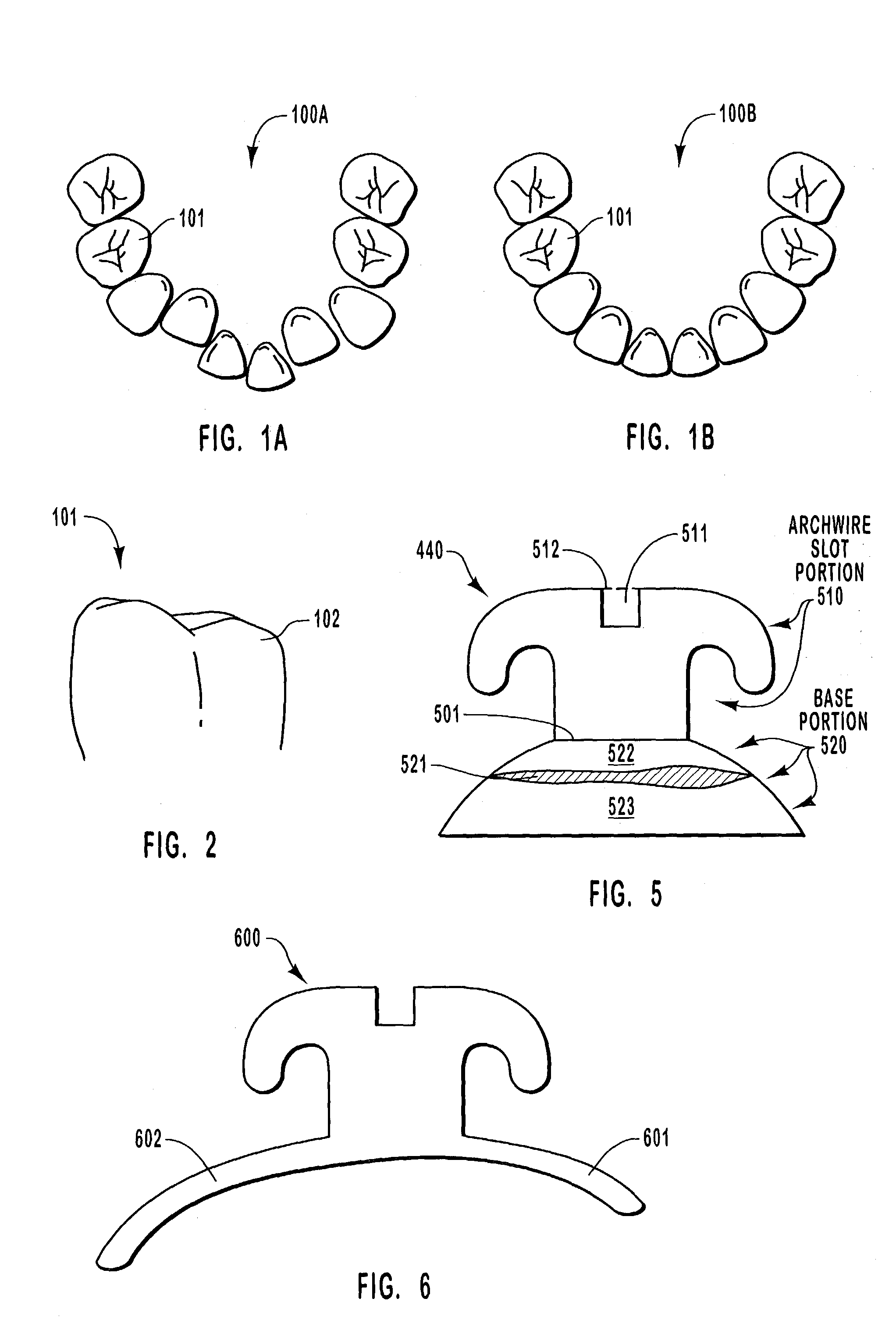 Custom-fitted orthodontic bracket manufactured by computerized and selective removal of portions of a bracket