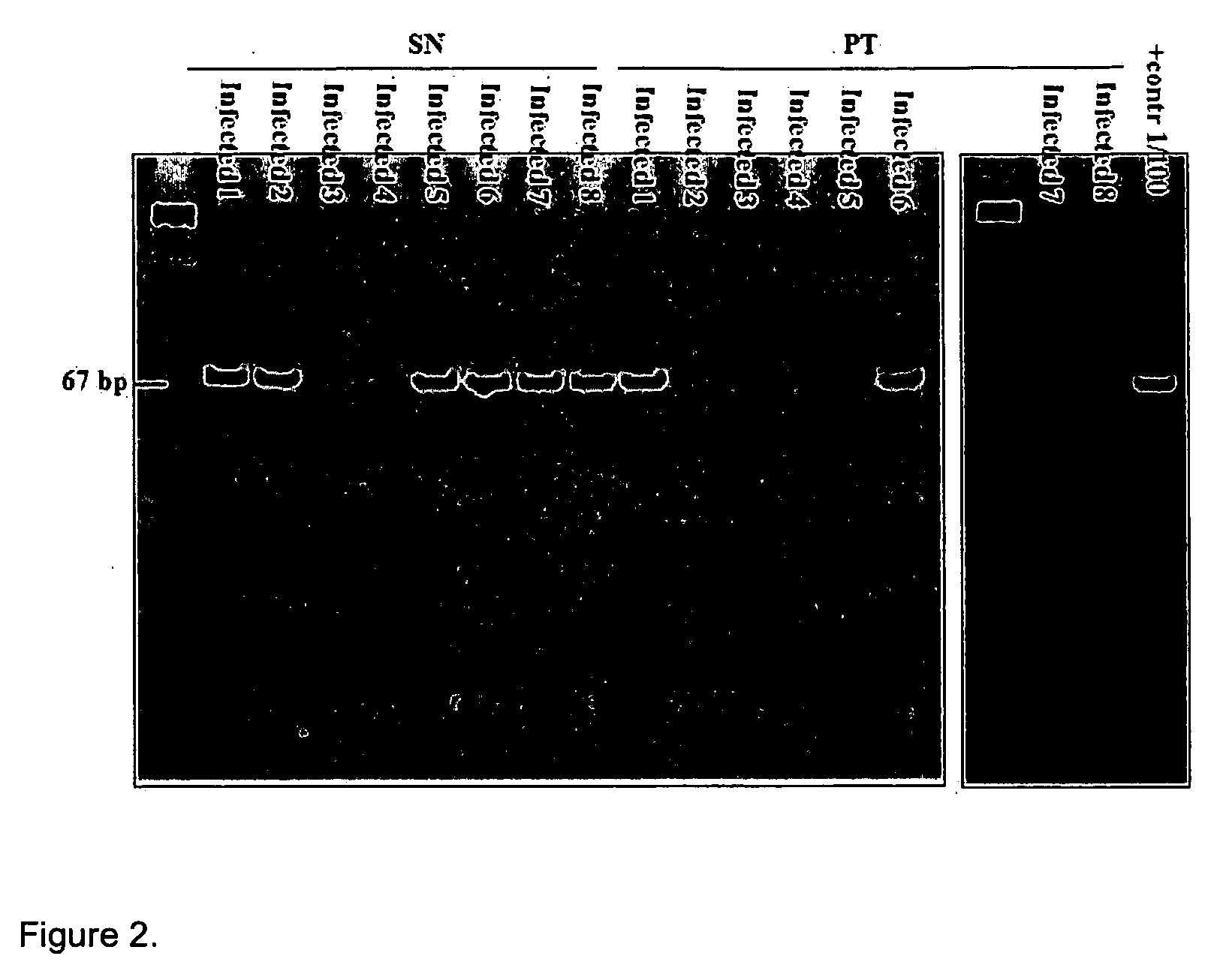 Method for diagnosis and monitoring of pathogenic infection by analysis of pathogenic transrenal nucleic acids in urine