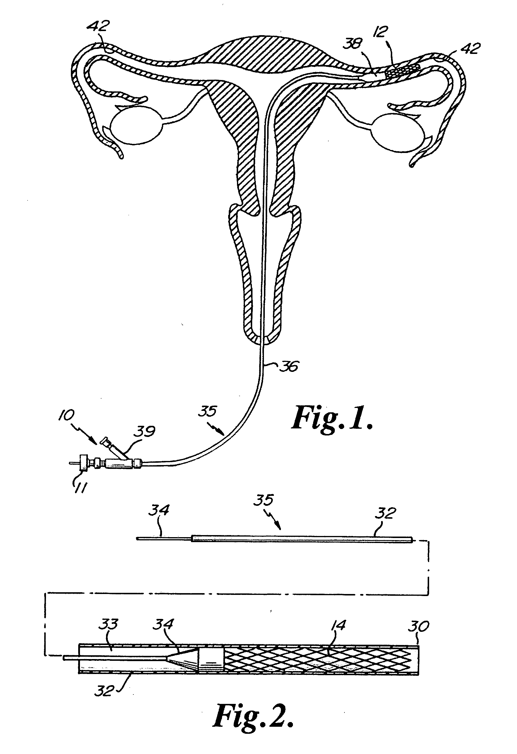 Hysteroscope Seal