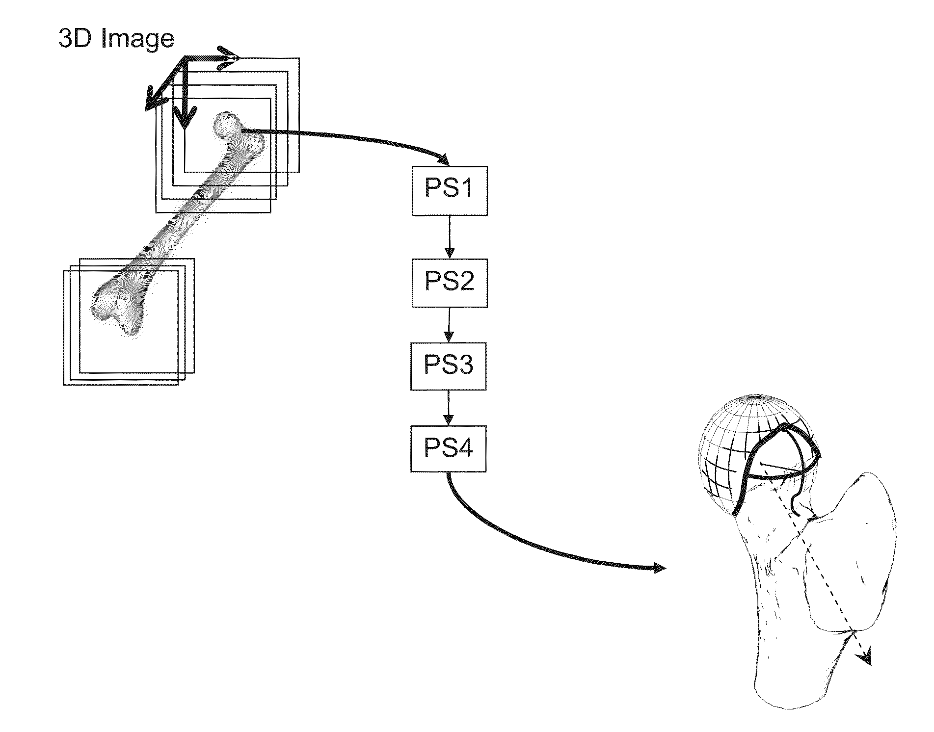 Method for determining bone resection on a deformed bone surface from few parameters