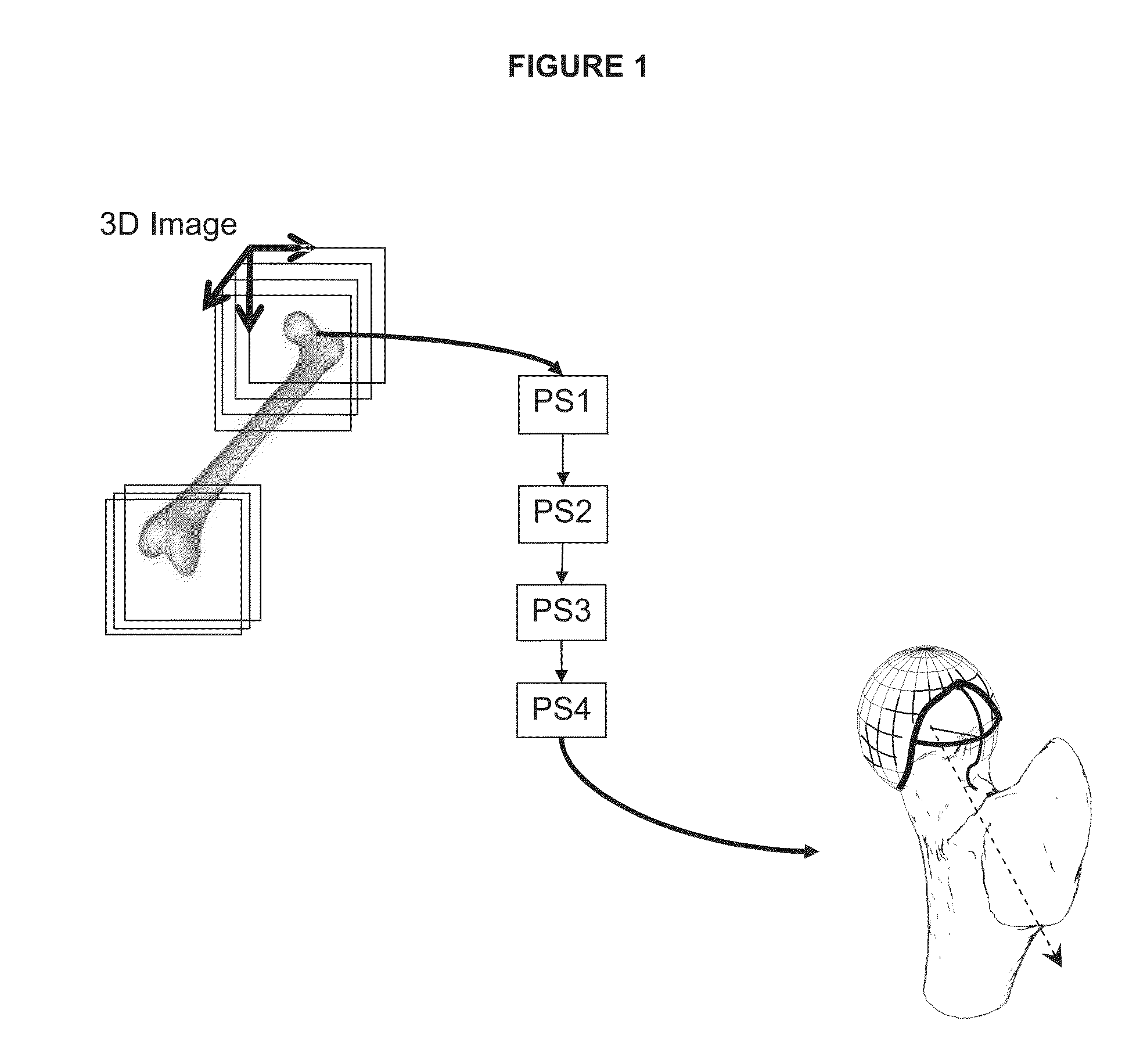 Method for determining bone resection on a deformed bone surface from few parameters