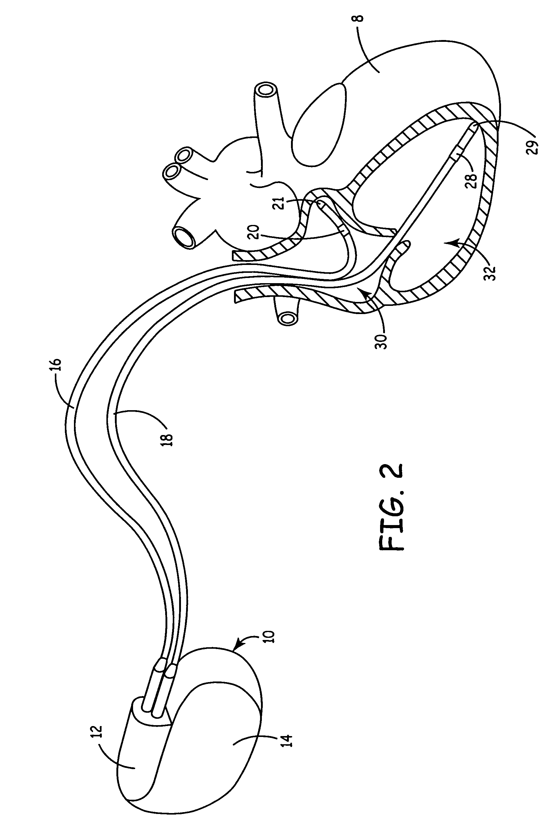 Implantable medical device with ventricular pacing protocol