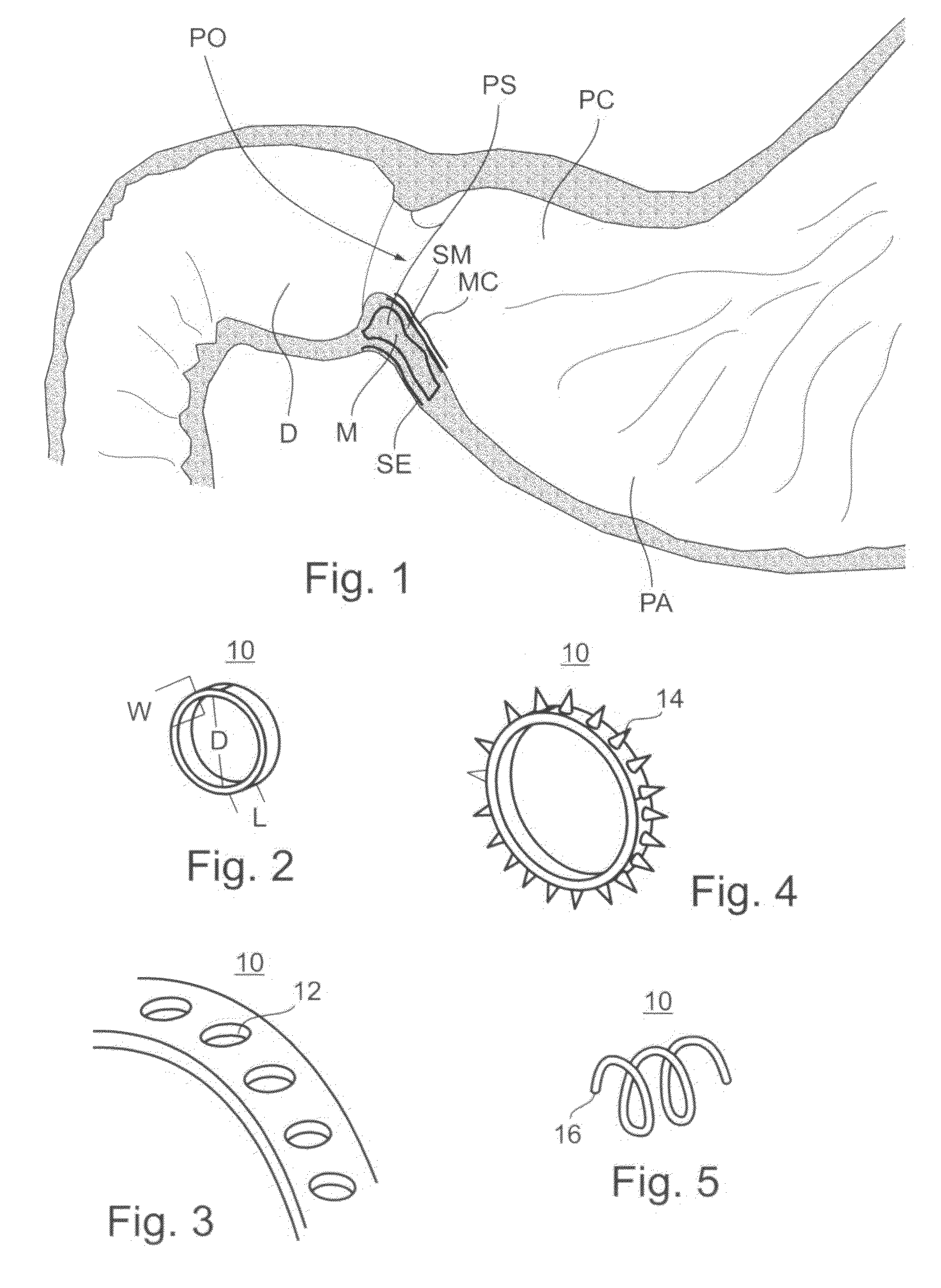 Pyloric Devices and Methods