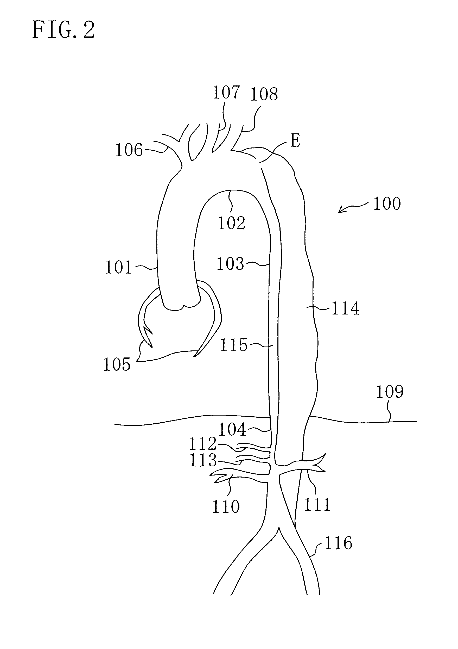 Instrument for dilating blood channel and instrument for treating aortic dissection