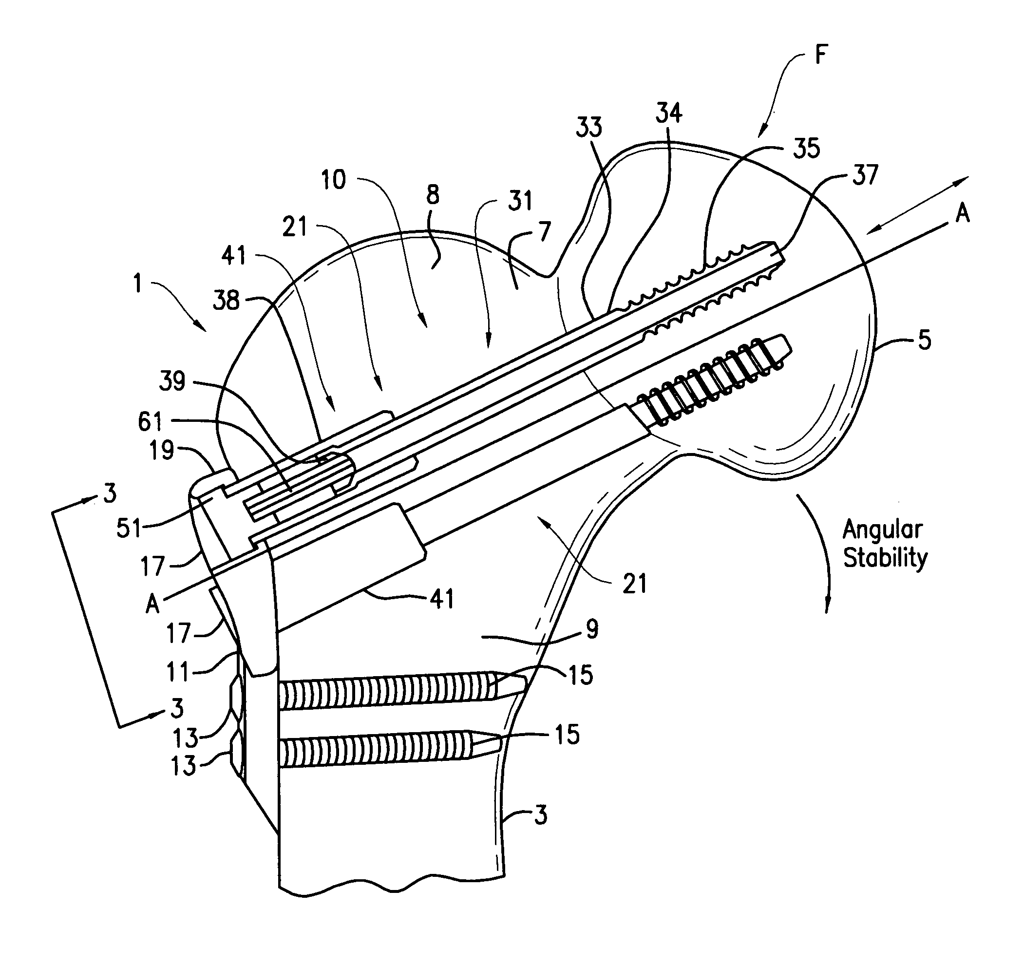 Hip fracture device with barrel and end cap for load control