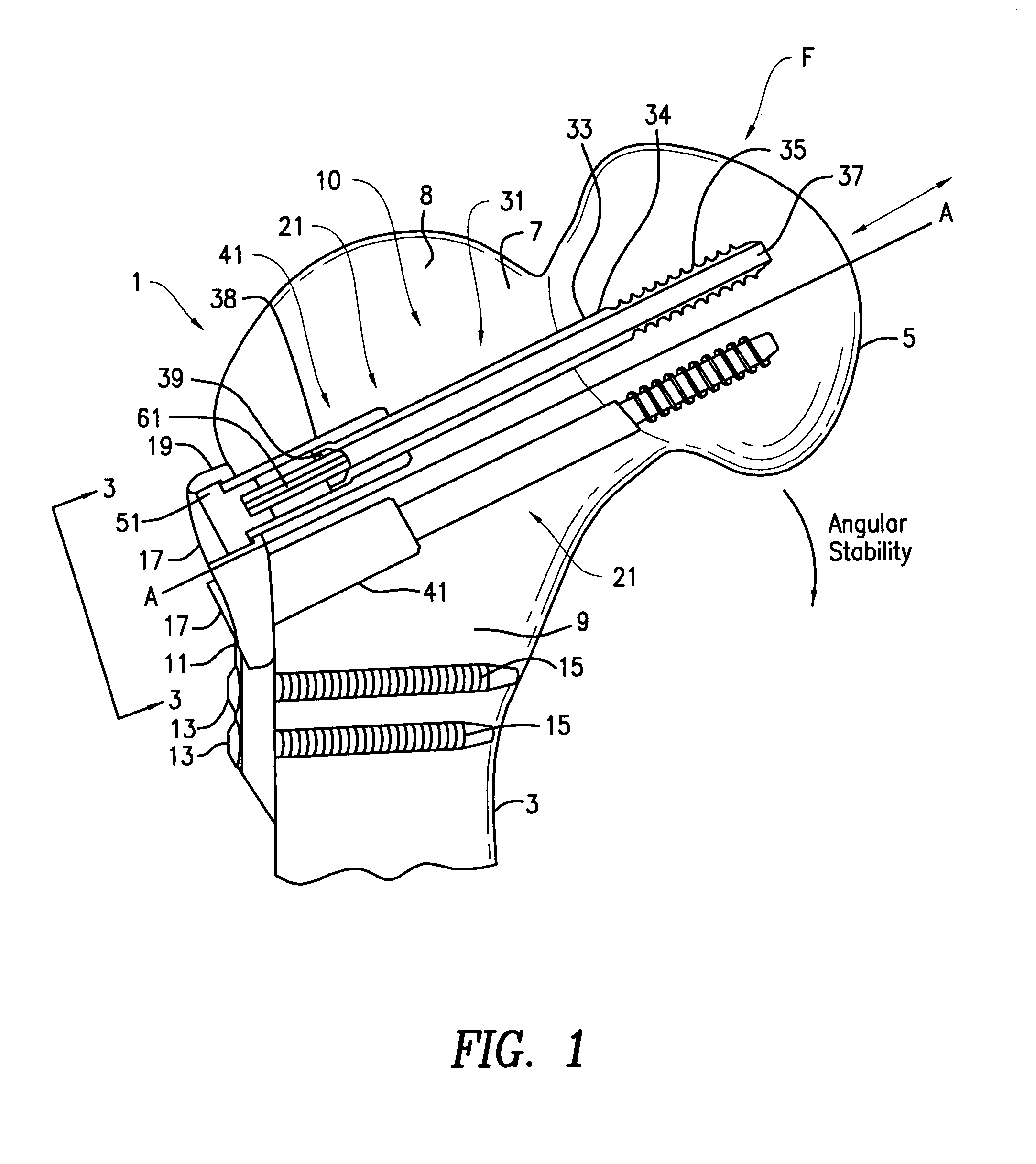 Hip fracture device with barrel and end cap for load control