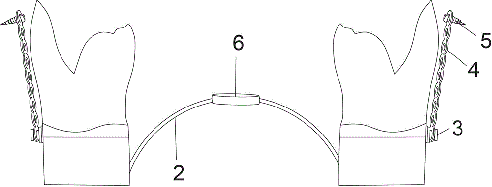 Device for integrally lowering posterior tooth segments