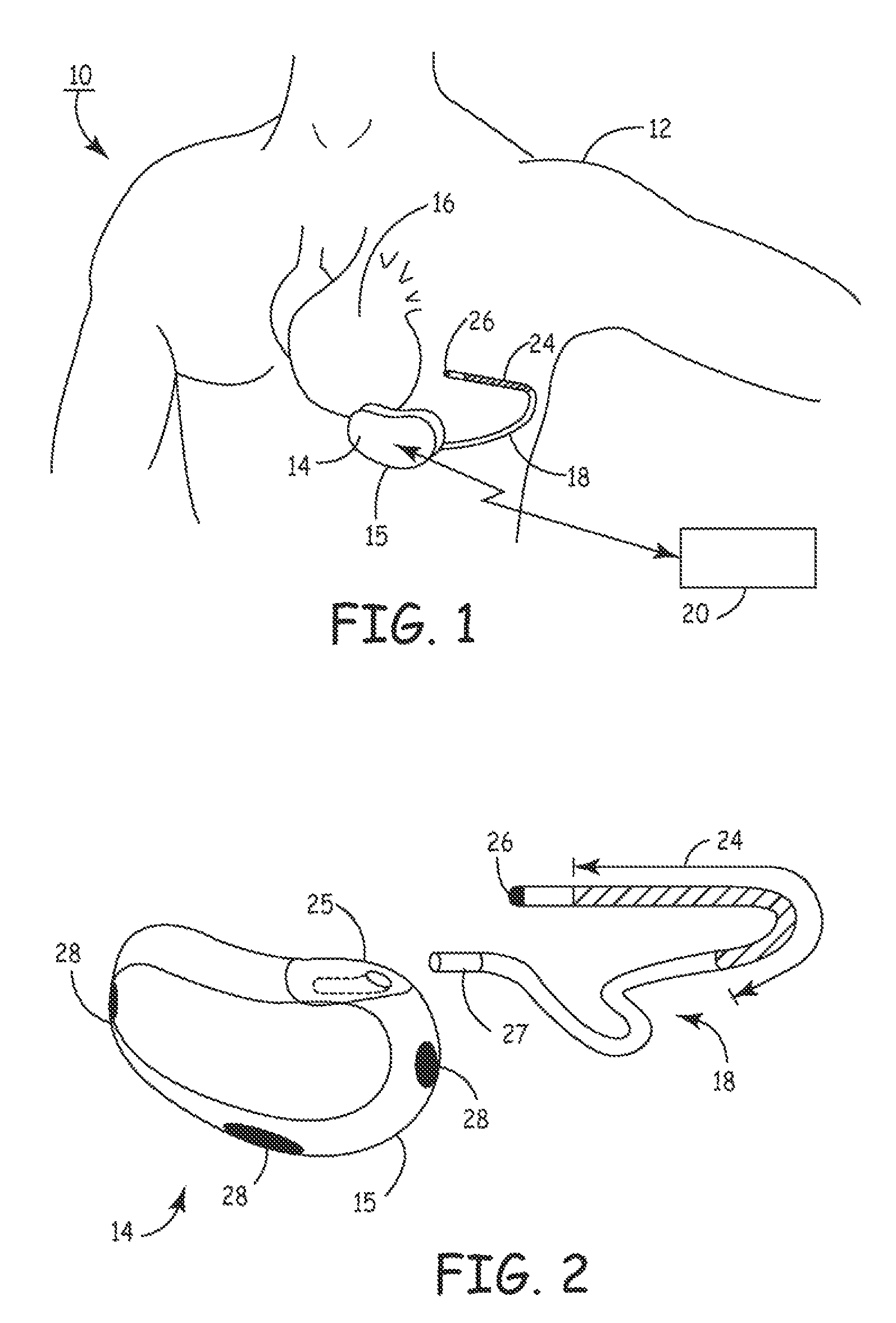 Method and apparatus for detecting arrhythmias in a subcutaneous medical device