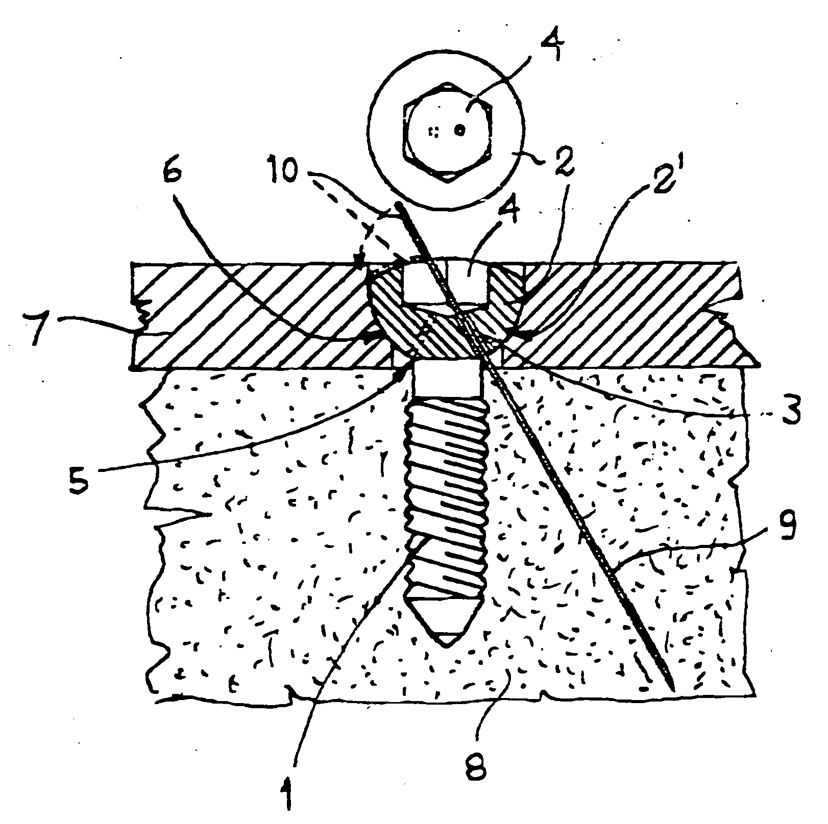 Surgical screw with spontaneous loosening preventive blocking system