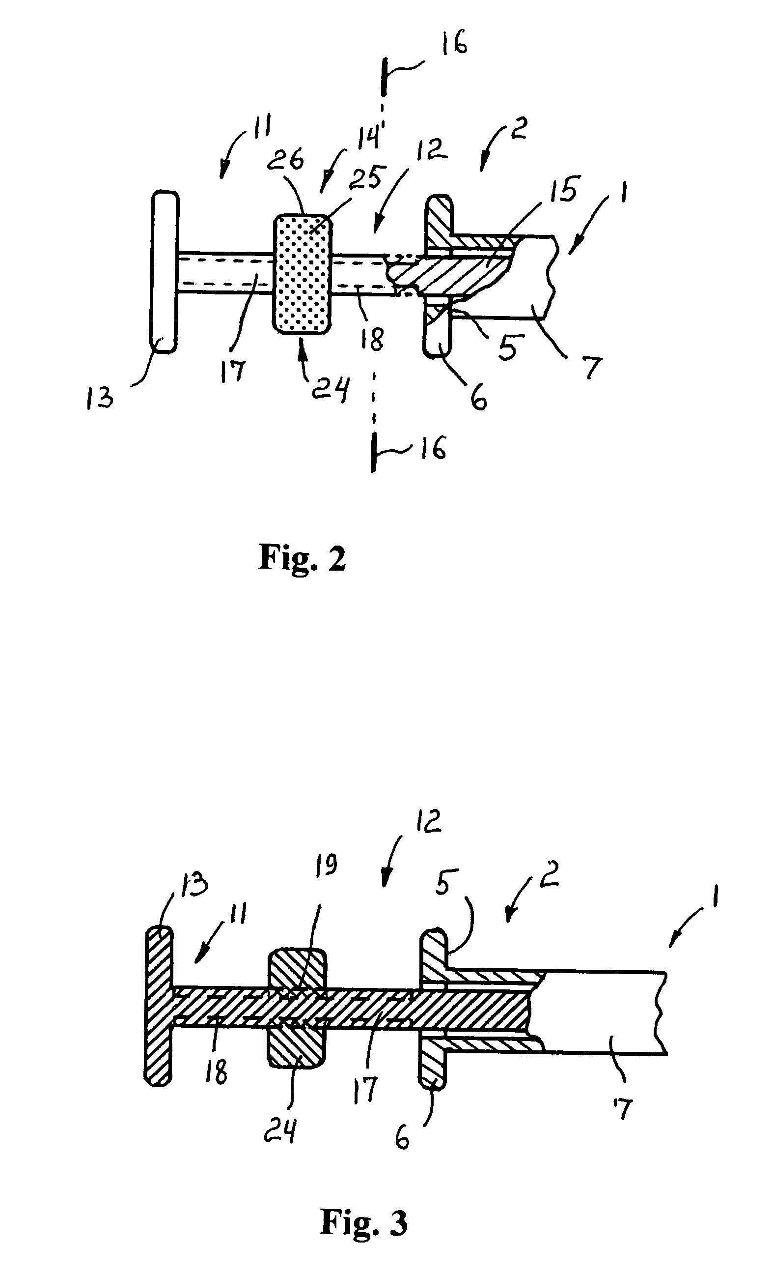 Apparatus for dental implant treatment