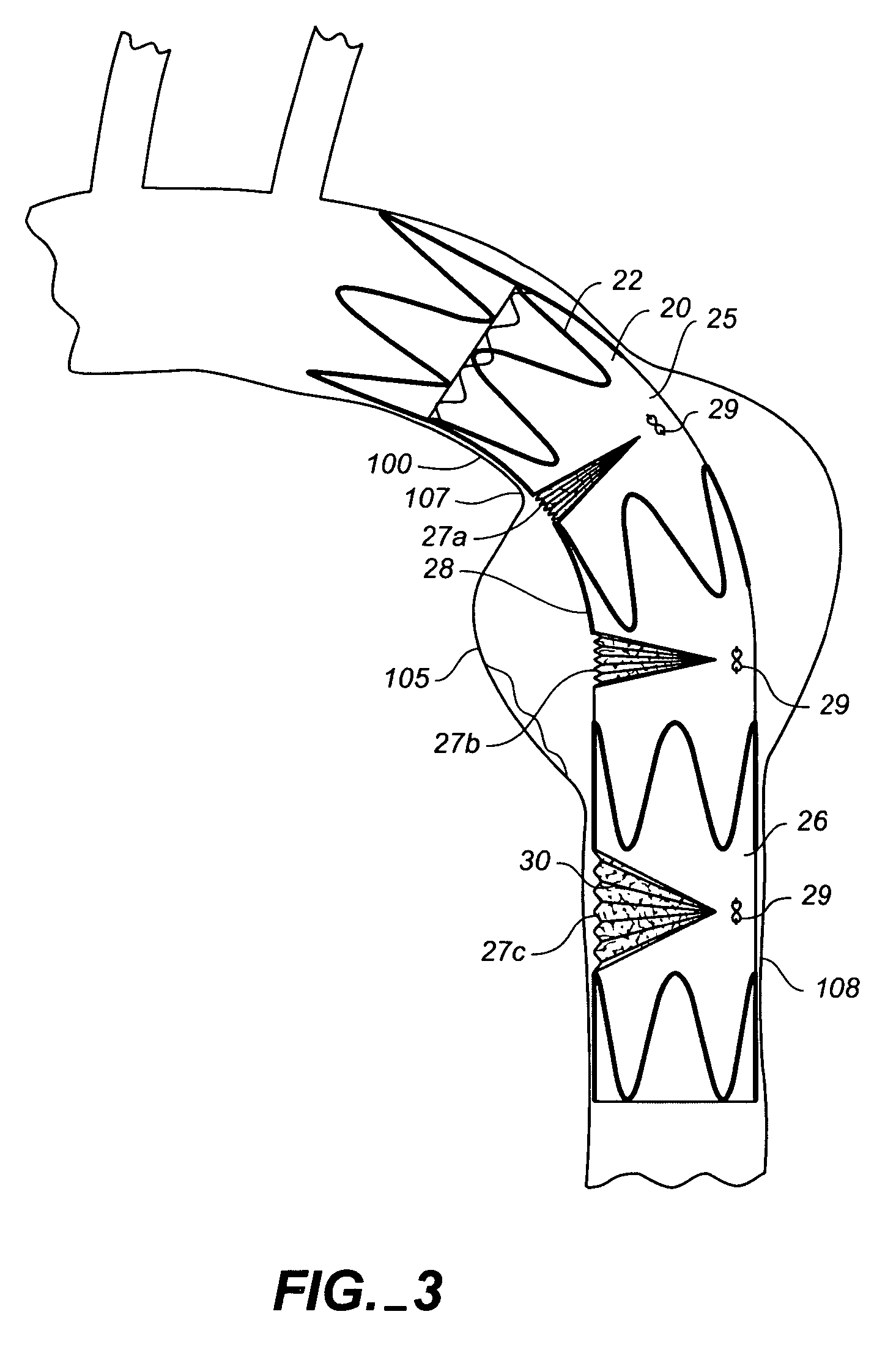 Endoluminal prosthesis having expandable graft sections