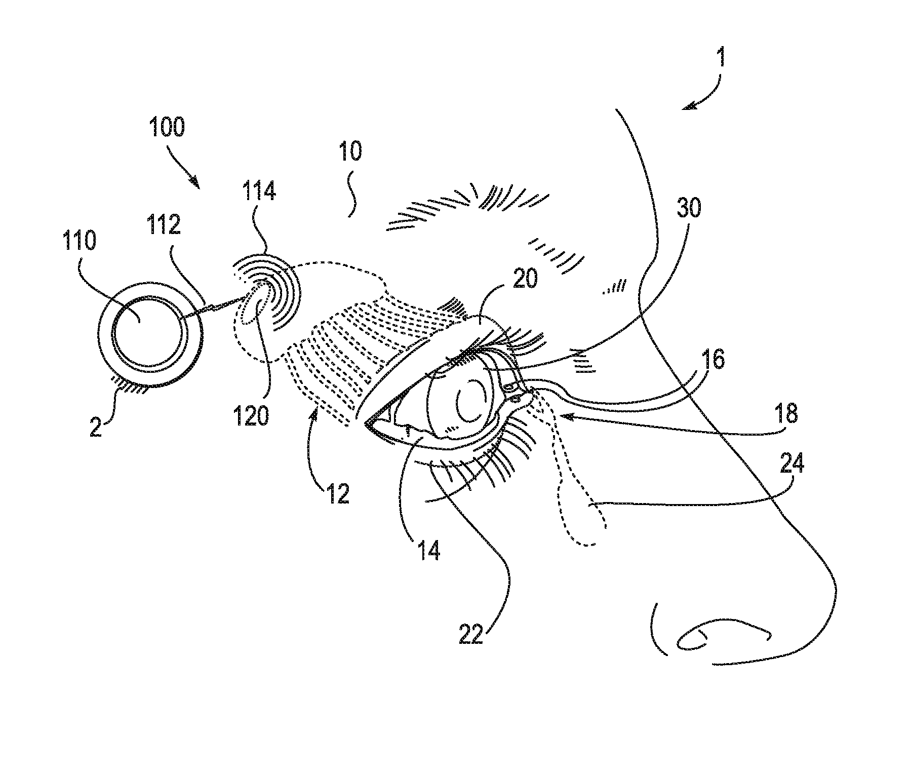 Systems and methods for treatment of dry eye