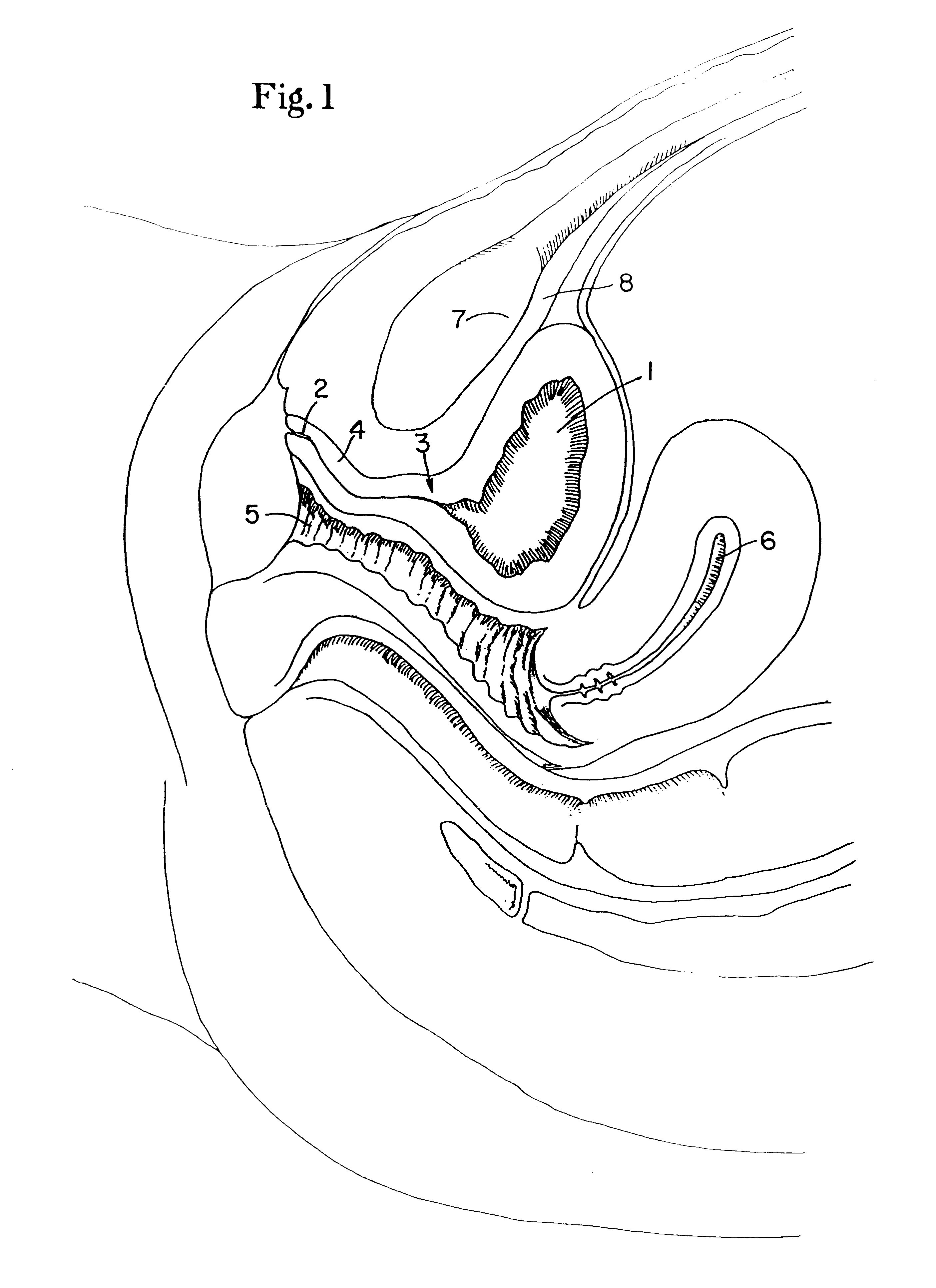 Surgical method for treating urinary incontinence, and apparatus for use in same