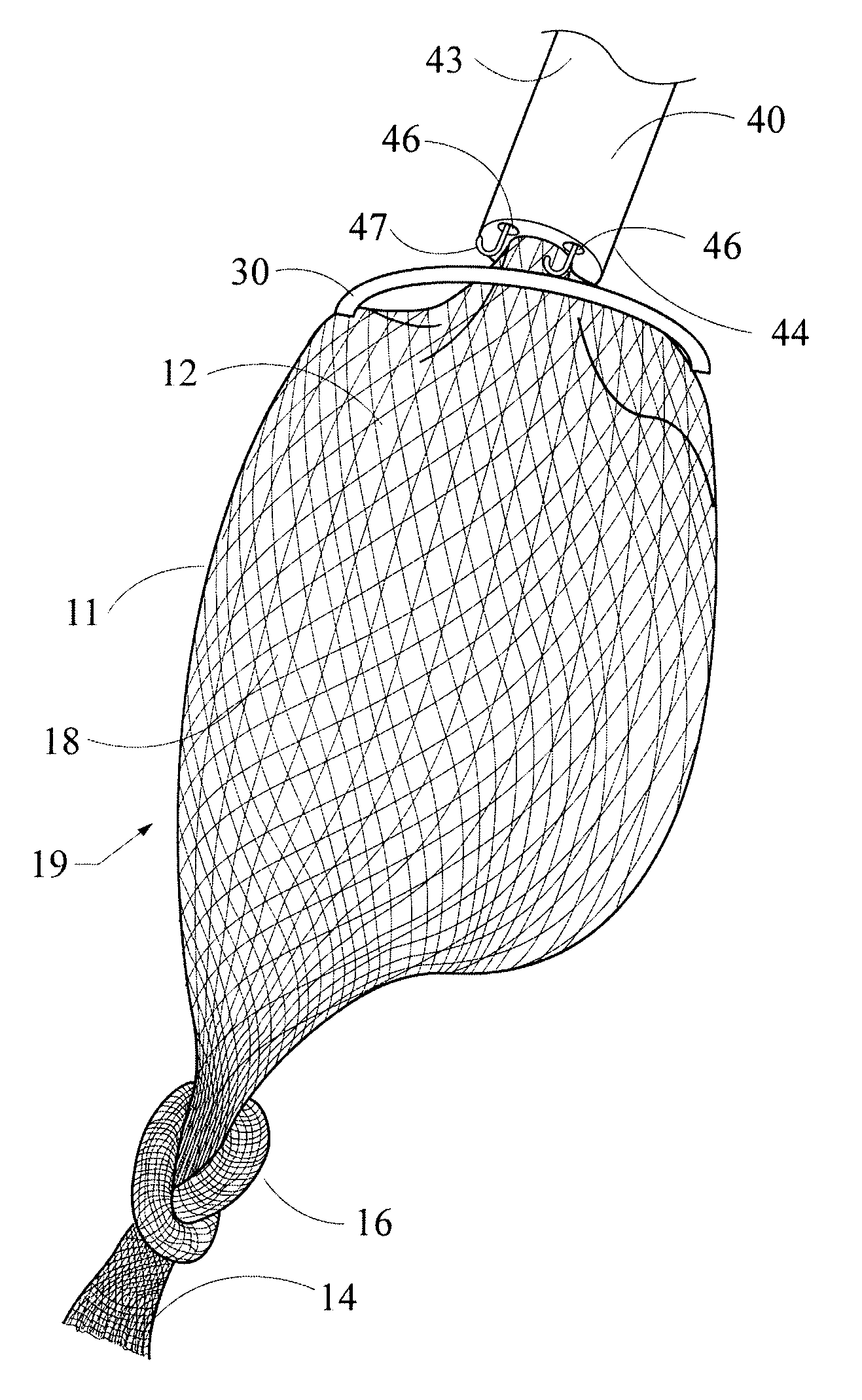 Intragastric bag apparatus and method of delivery for treating obesity