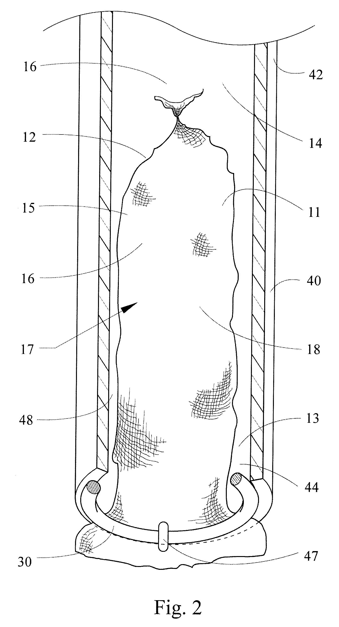 Intragastric bag apparatus and method of delivery for treating obesity