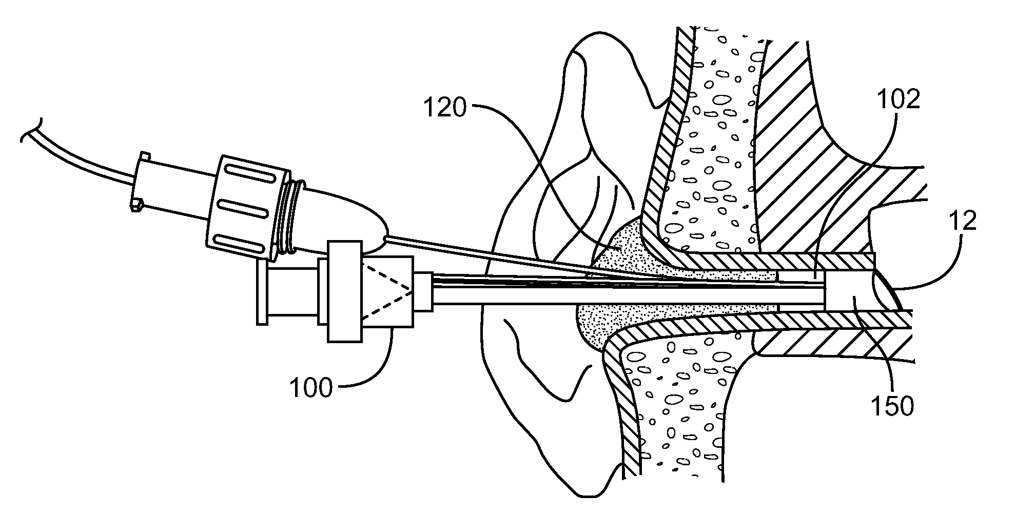 System and Method for the Simultaneous Bilateral Integrated Tympanic Drug Delivery and Guided Treatment of Target Tissues Within the Ears