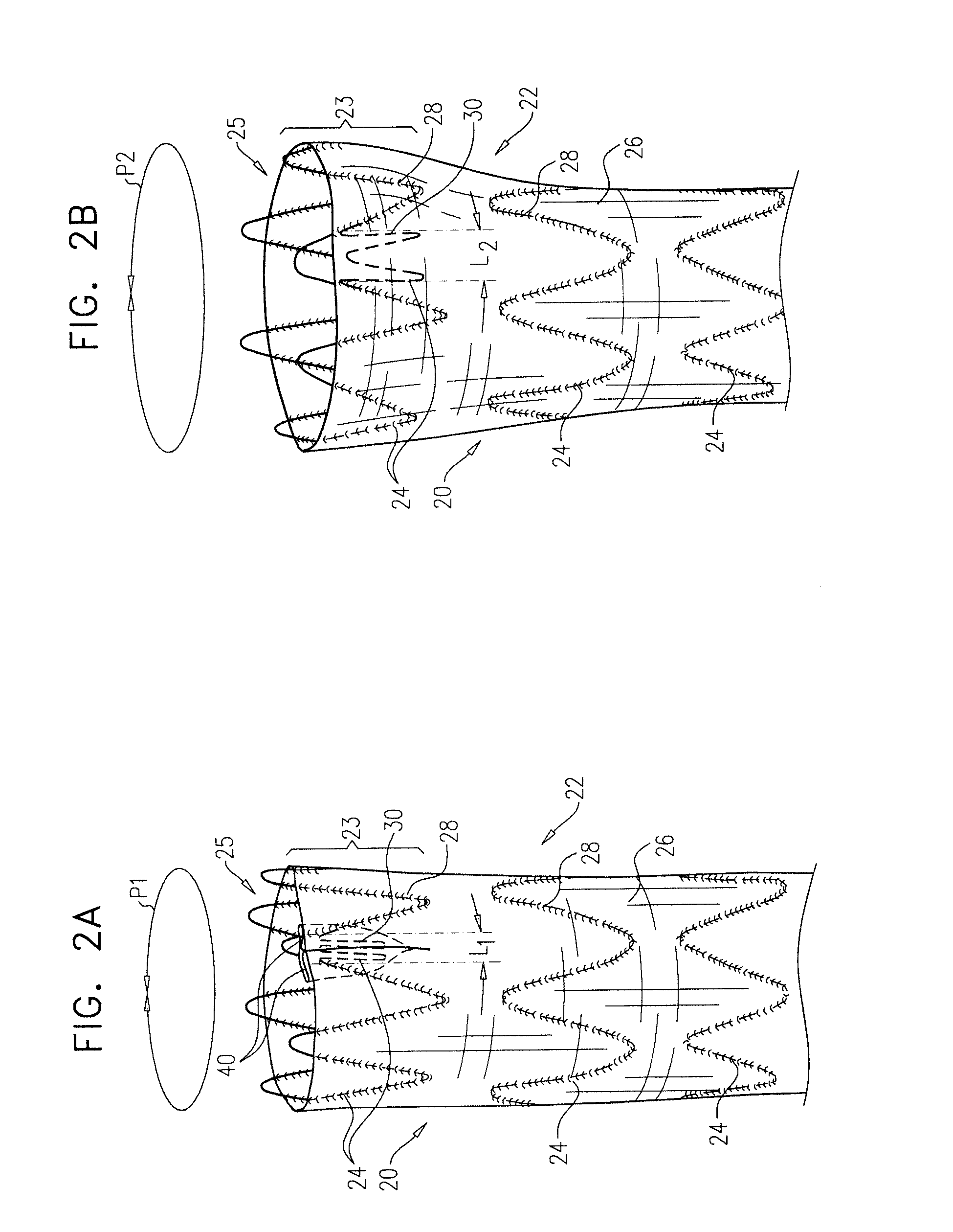 Stent-grafts configured for post-implantation expansion