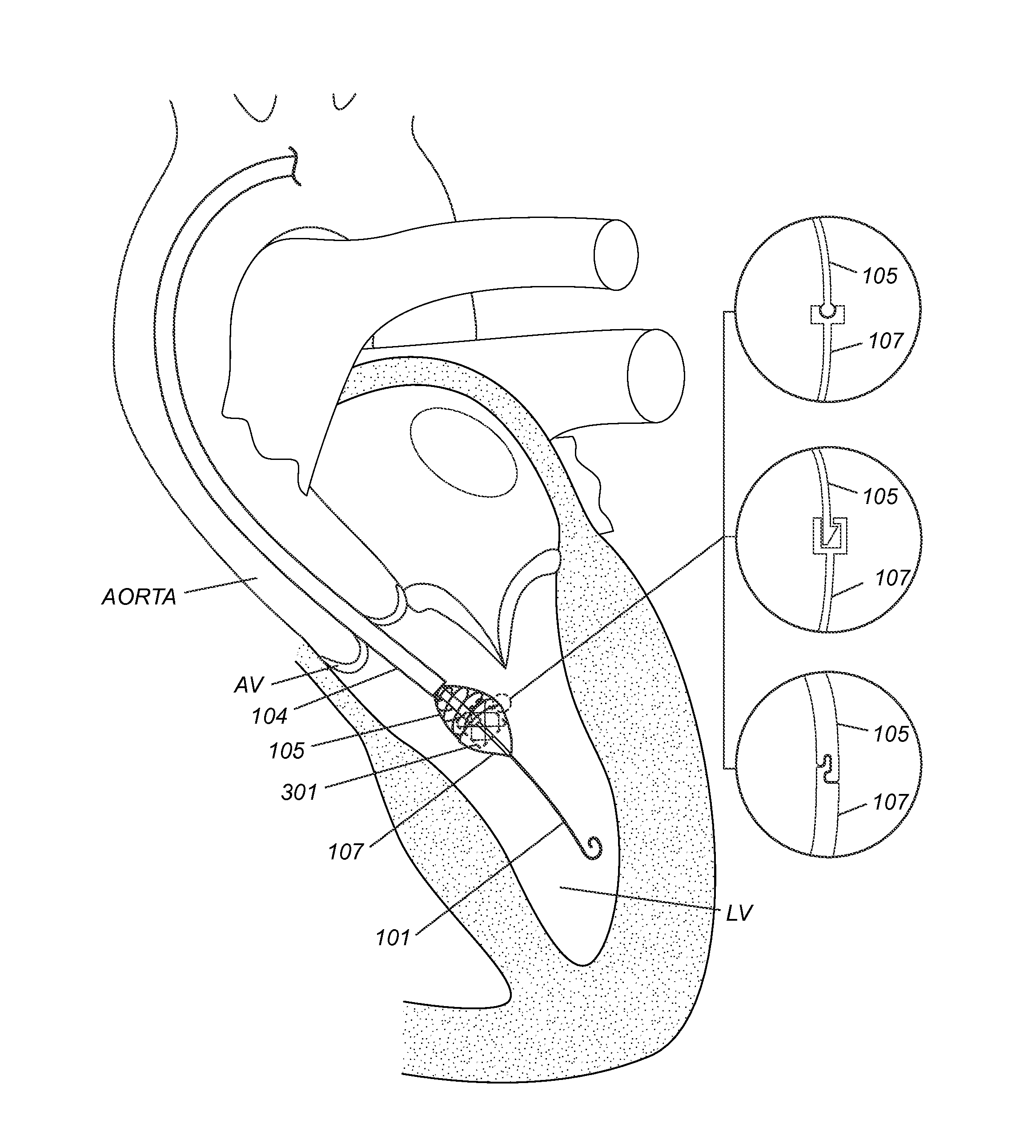 Device to percutaneously treat heart valve embolization