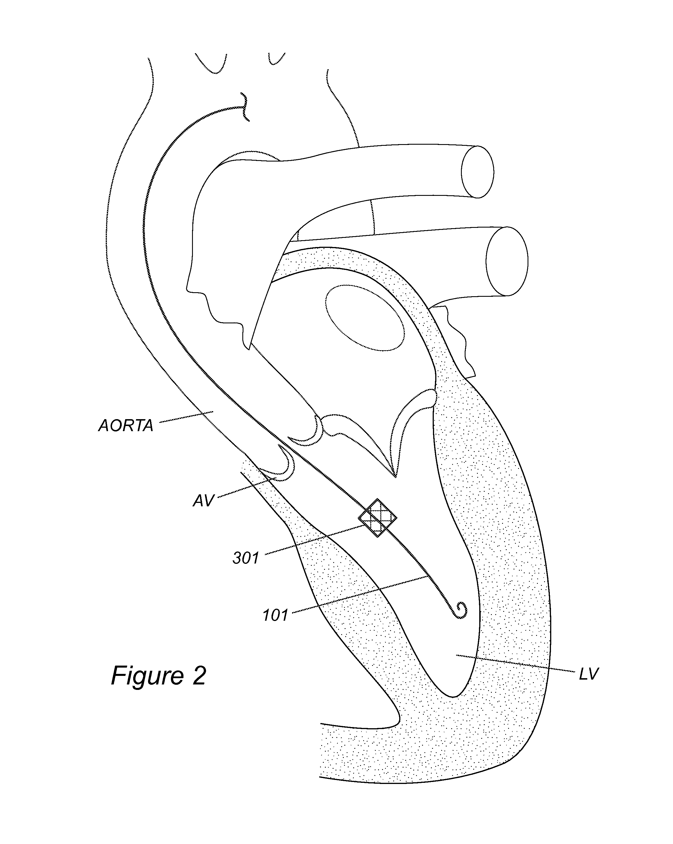 Device to percutaneously treat heart valve embolization