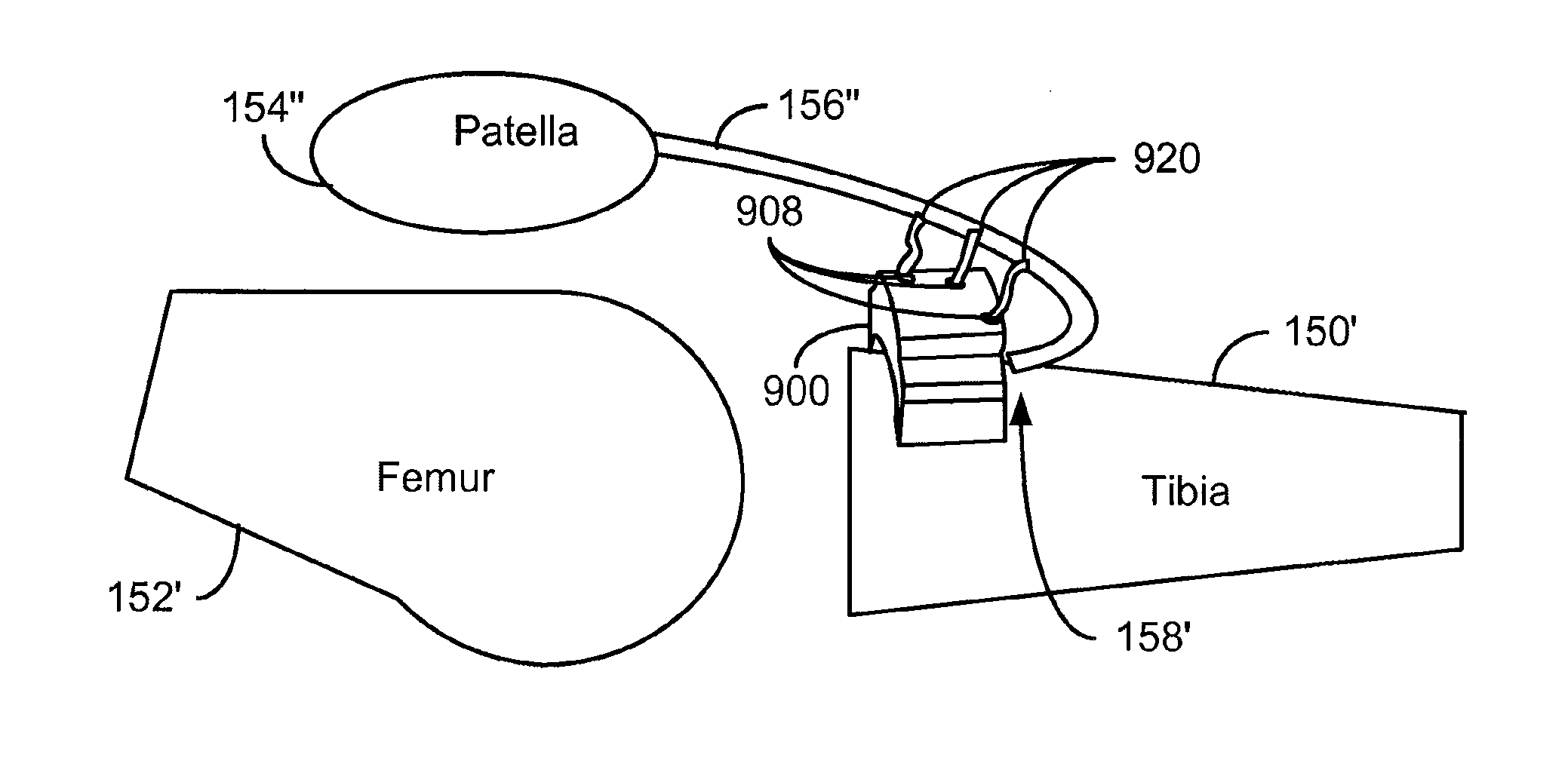 Method and System for Patella Realignment