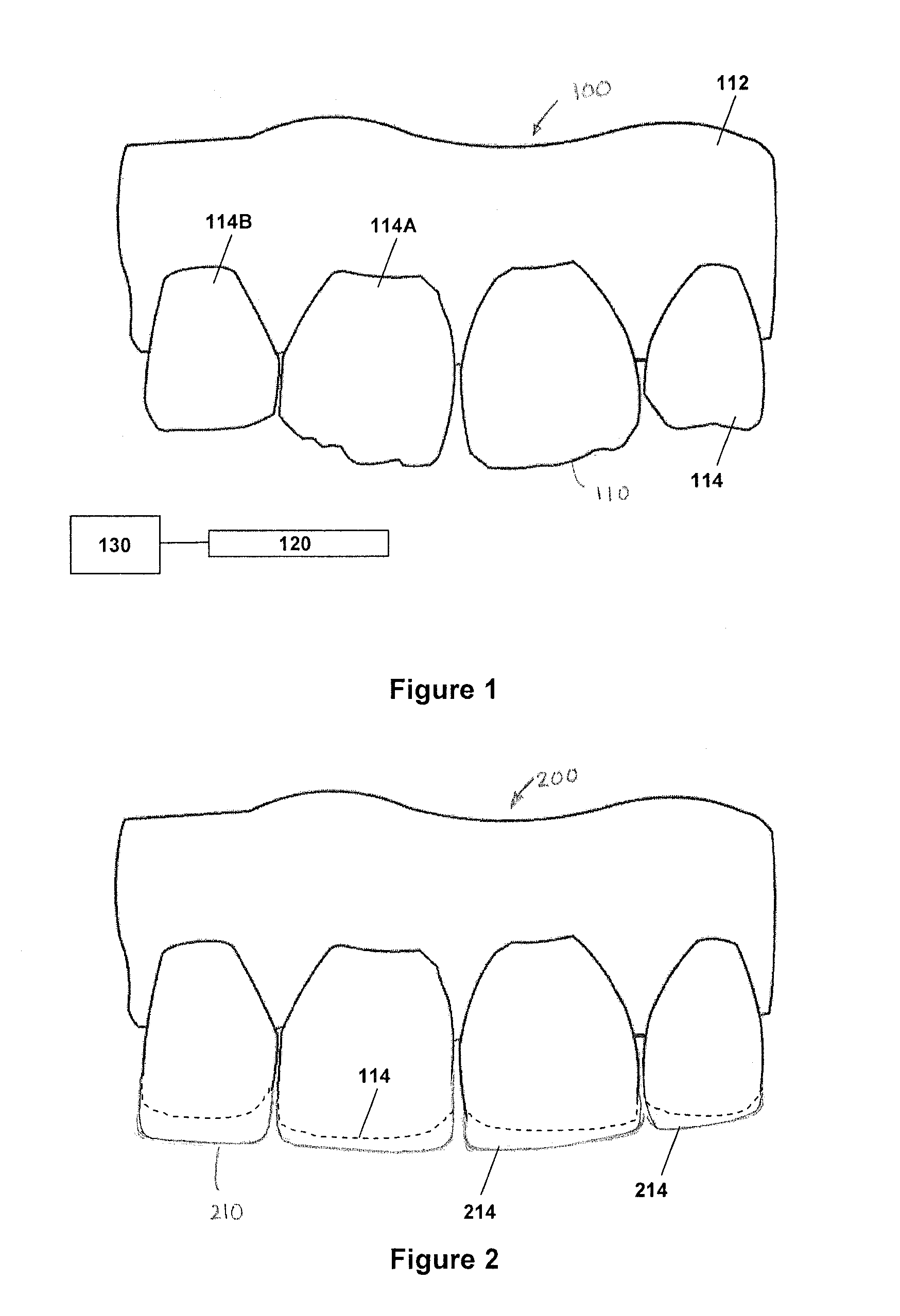 Method for dental restoration and related kit