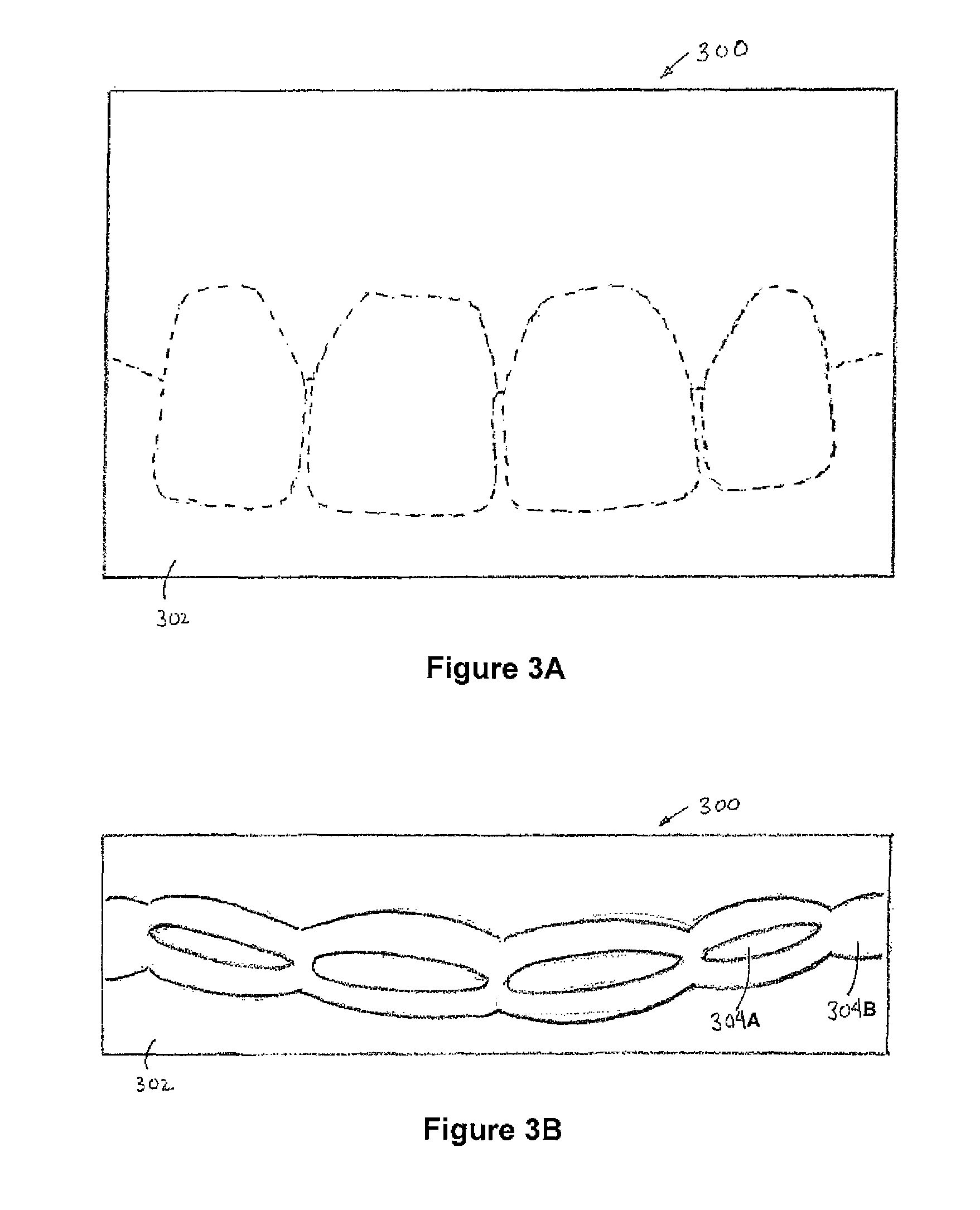 Method for dental restoration and related kit