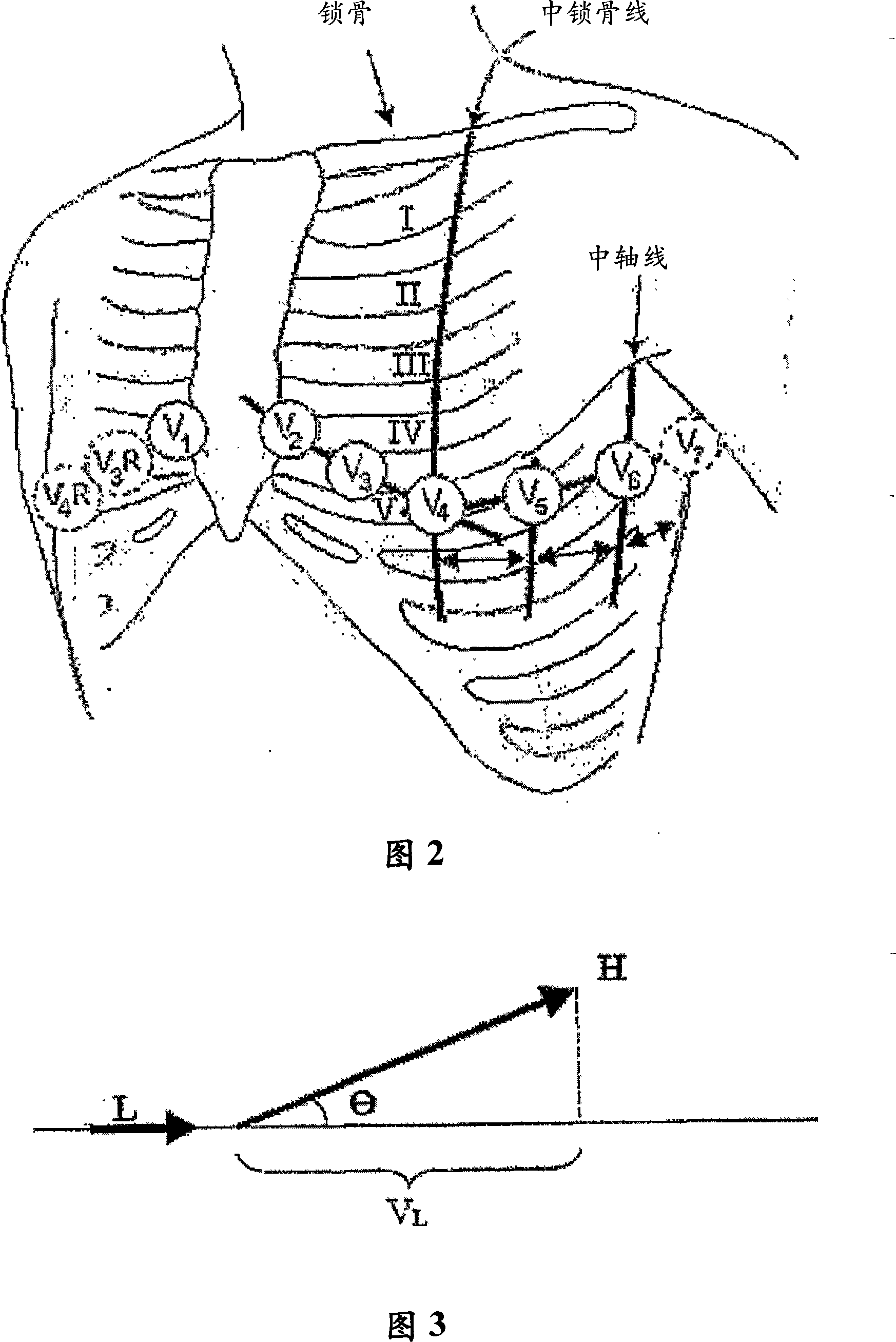 System, method and apparatus for detecting a cardiac event