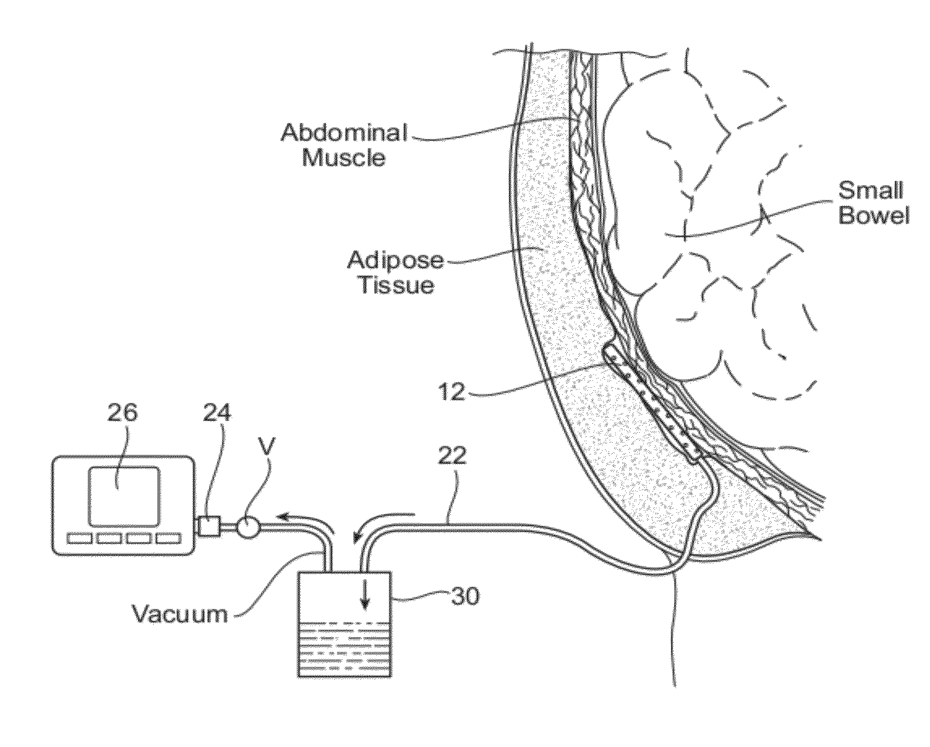 Assemblies, systems, and methods for vacuum assisted internal drainage during wound healing