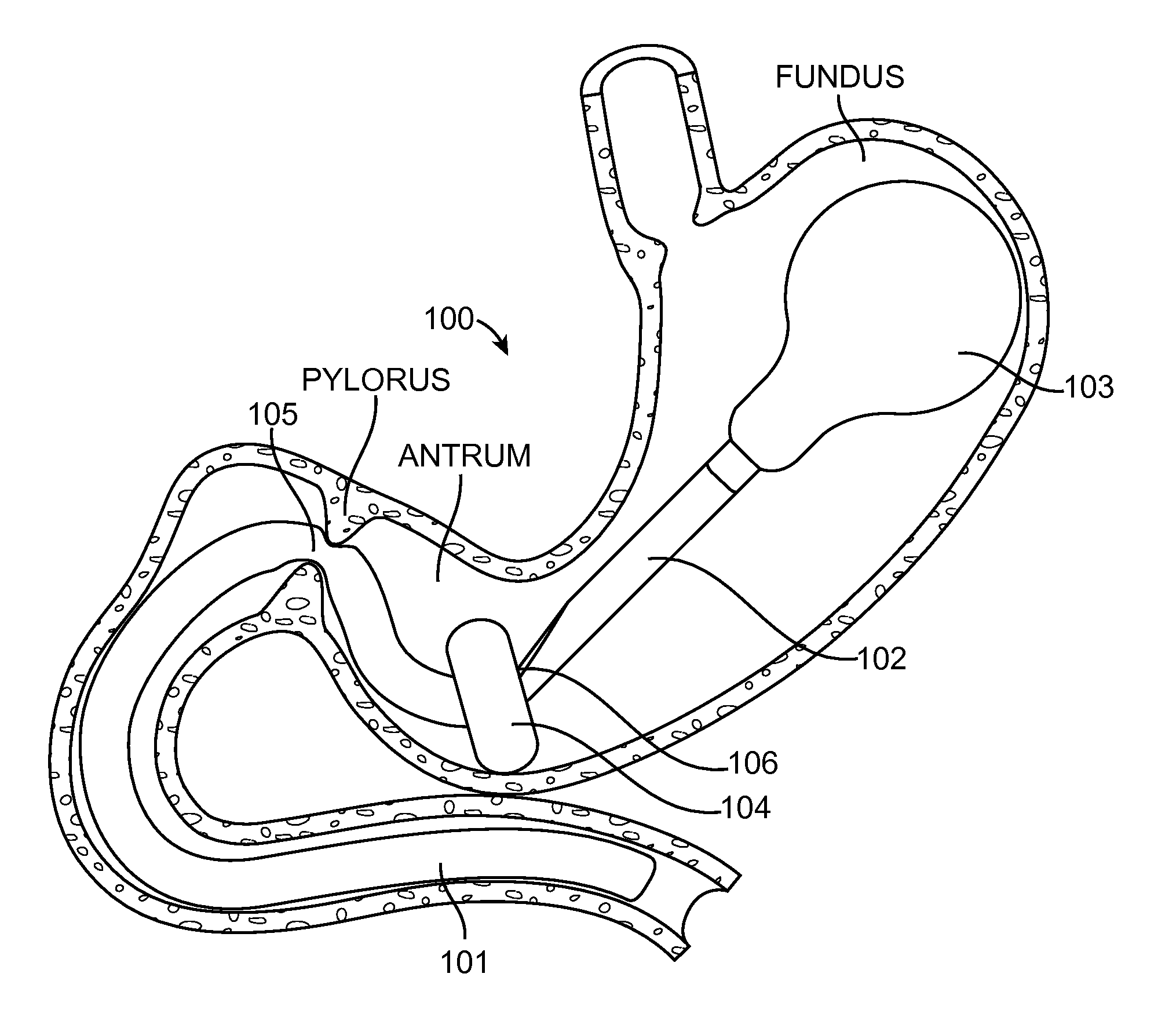 Intragastric Implant Devices