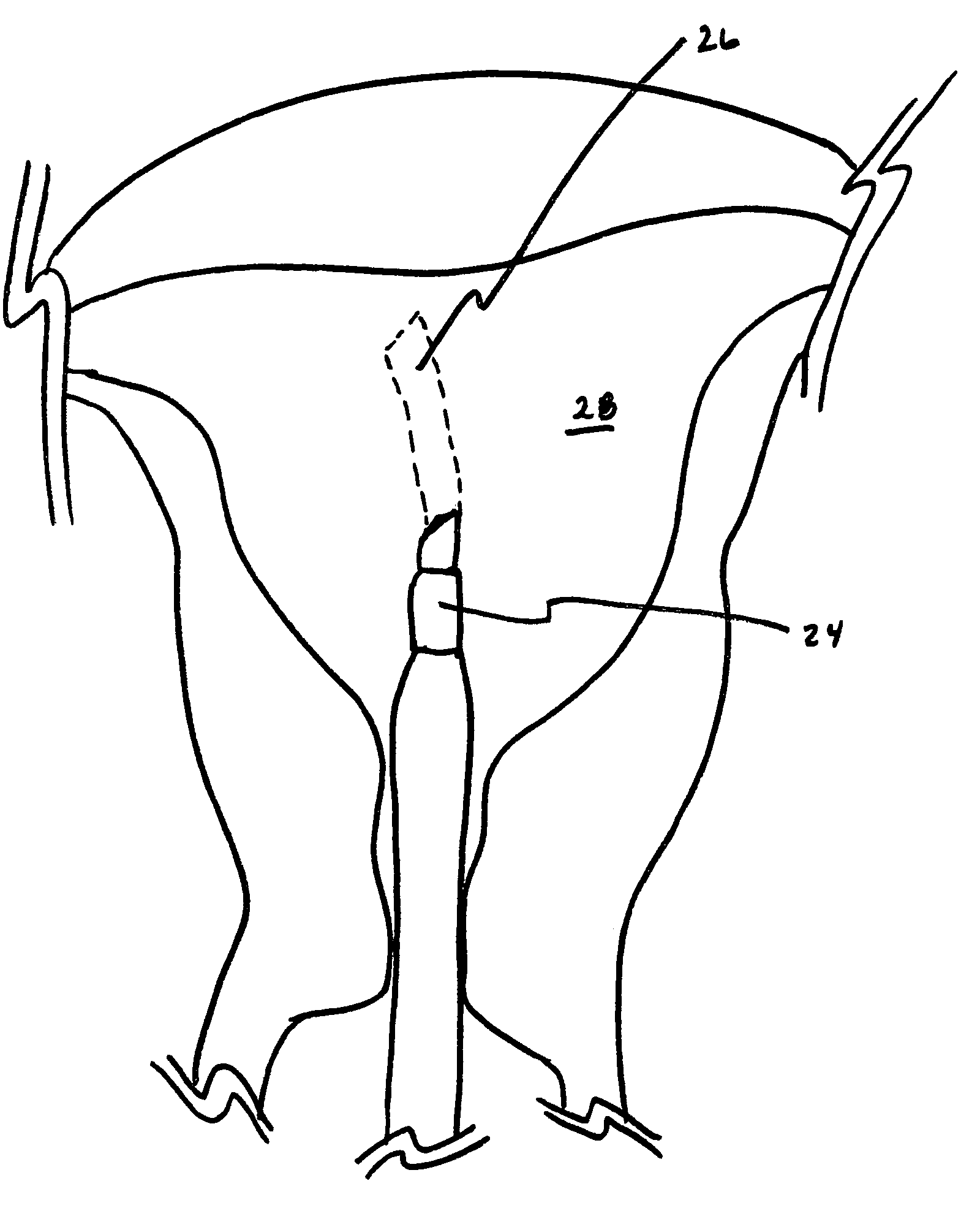 Method and apparatus for creating intrauterine adhesions