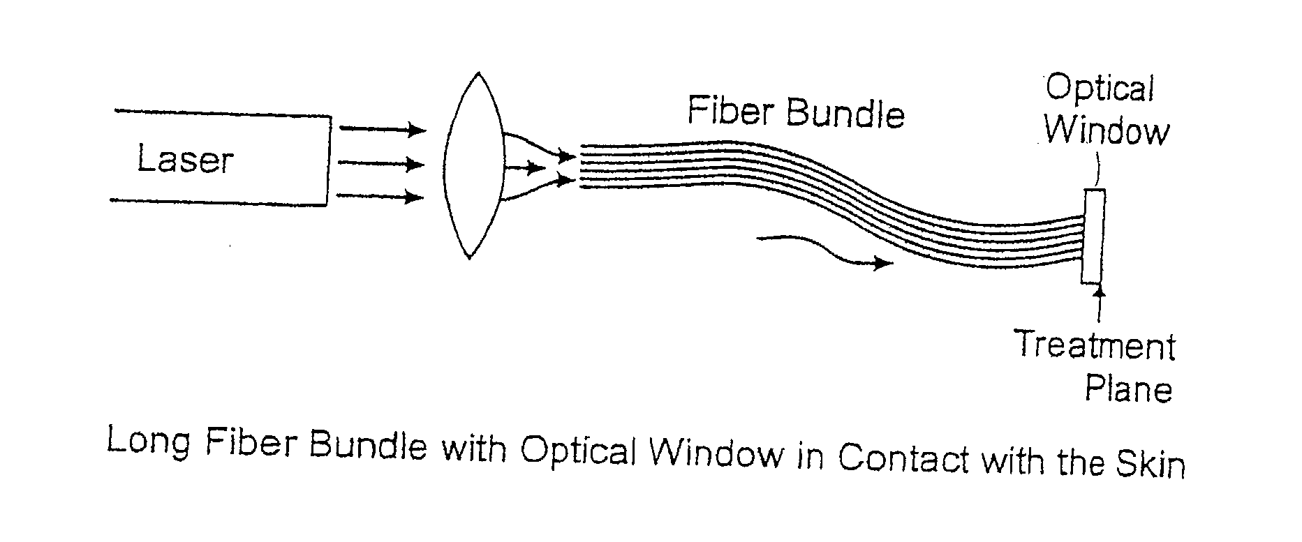 Methods And Systems For Laser Treatment Using Non-Uniform Output Beam