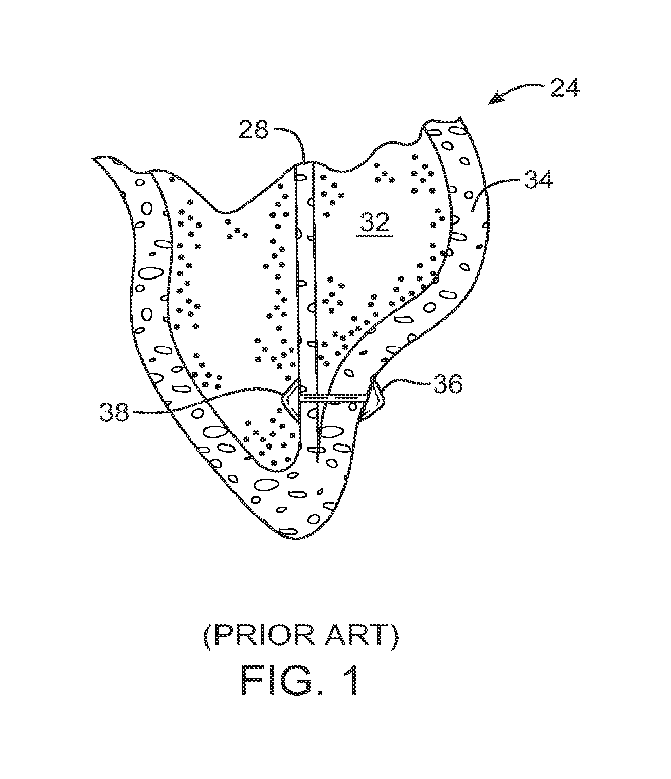 Steerable Lesion Excluding Heart Implants For Congestive Heart Failure