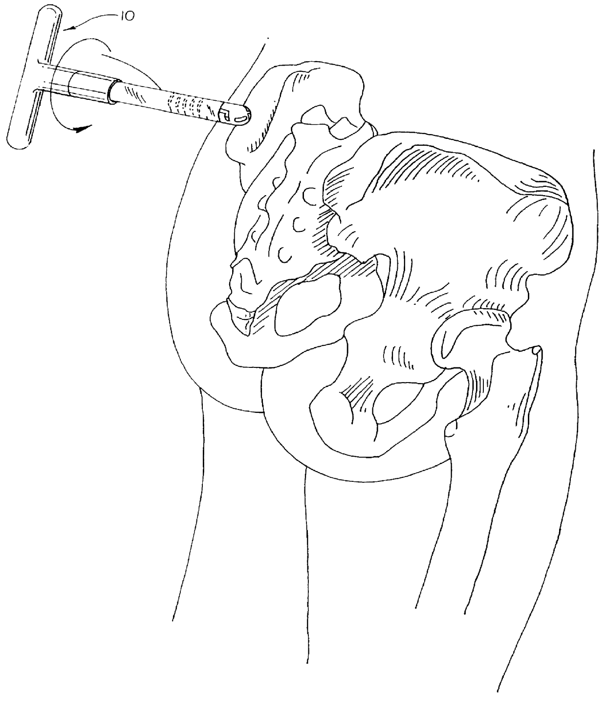 Graduated bone graft harvester