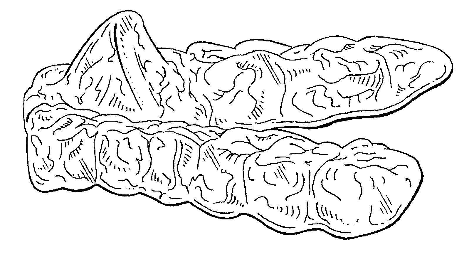 Snore relief with mandibular positioning device