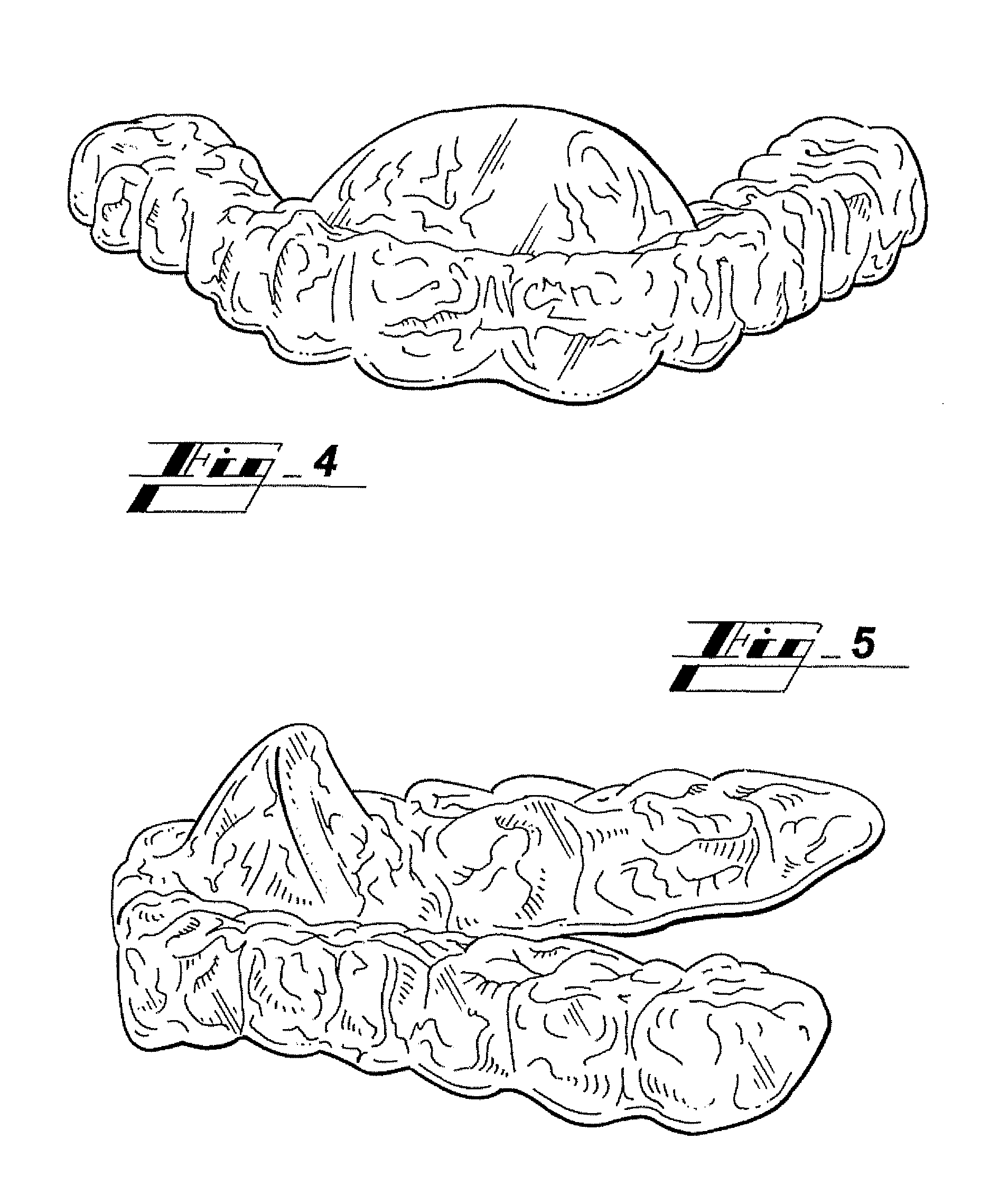 Snore relief with mandibular positioning device