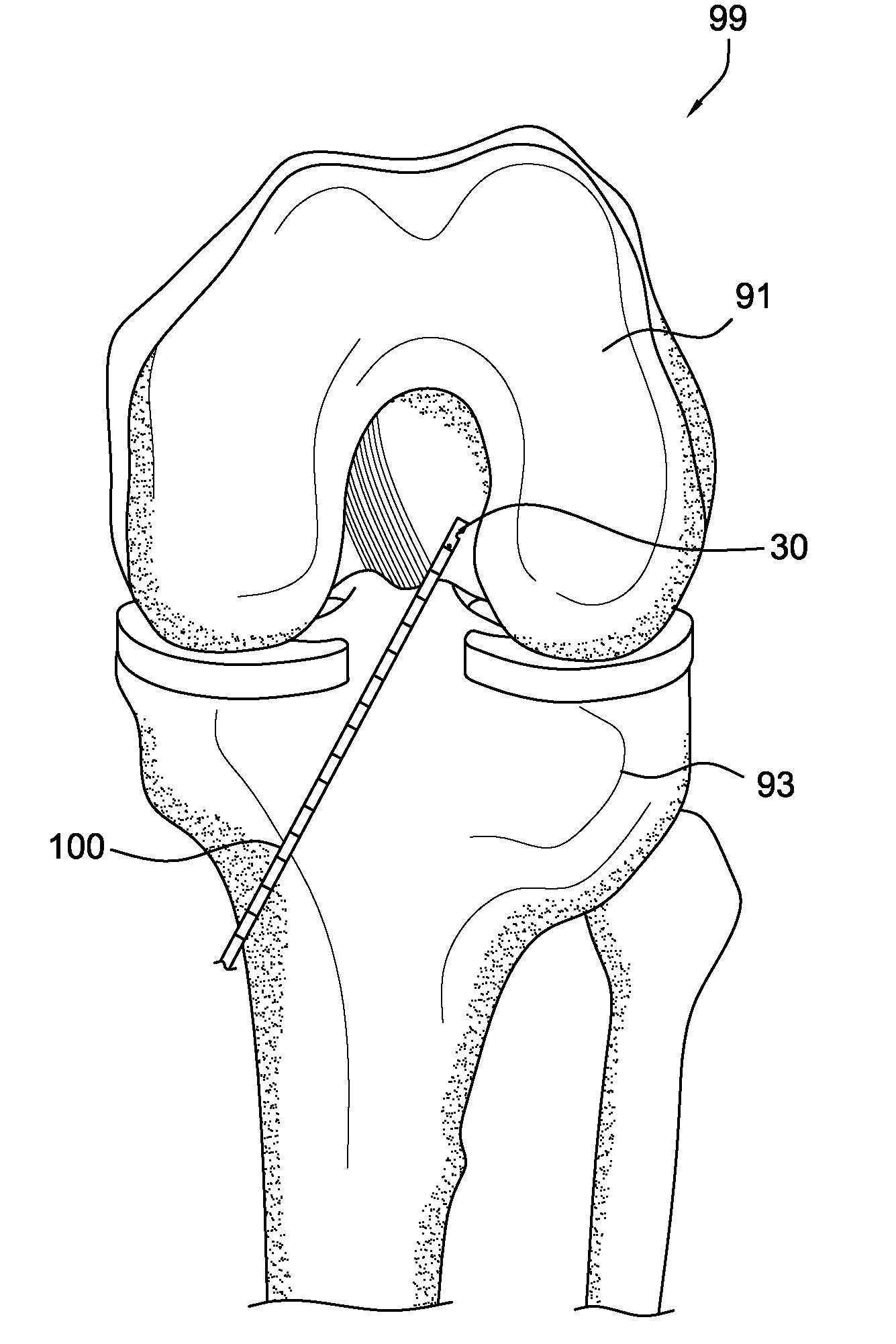 Retrograde cutter with rotating blade