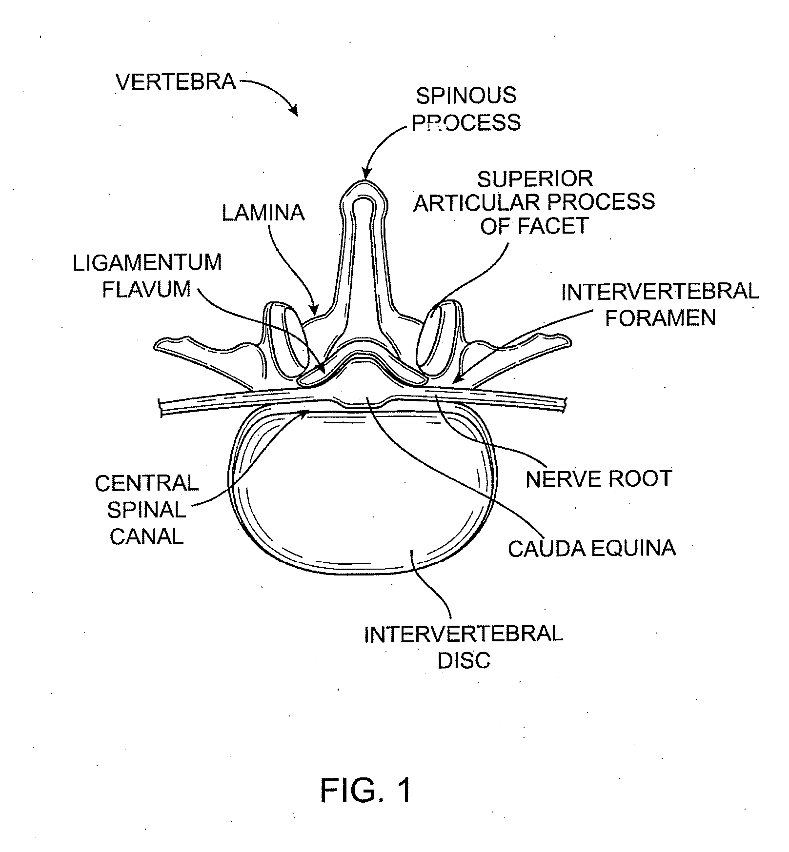 Percutaneous spinal stenosis treatment