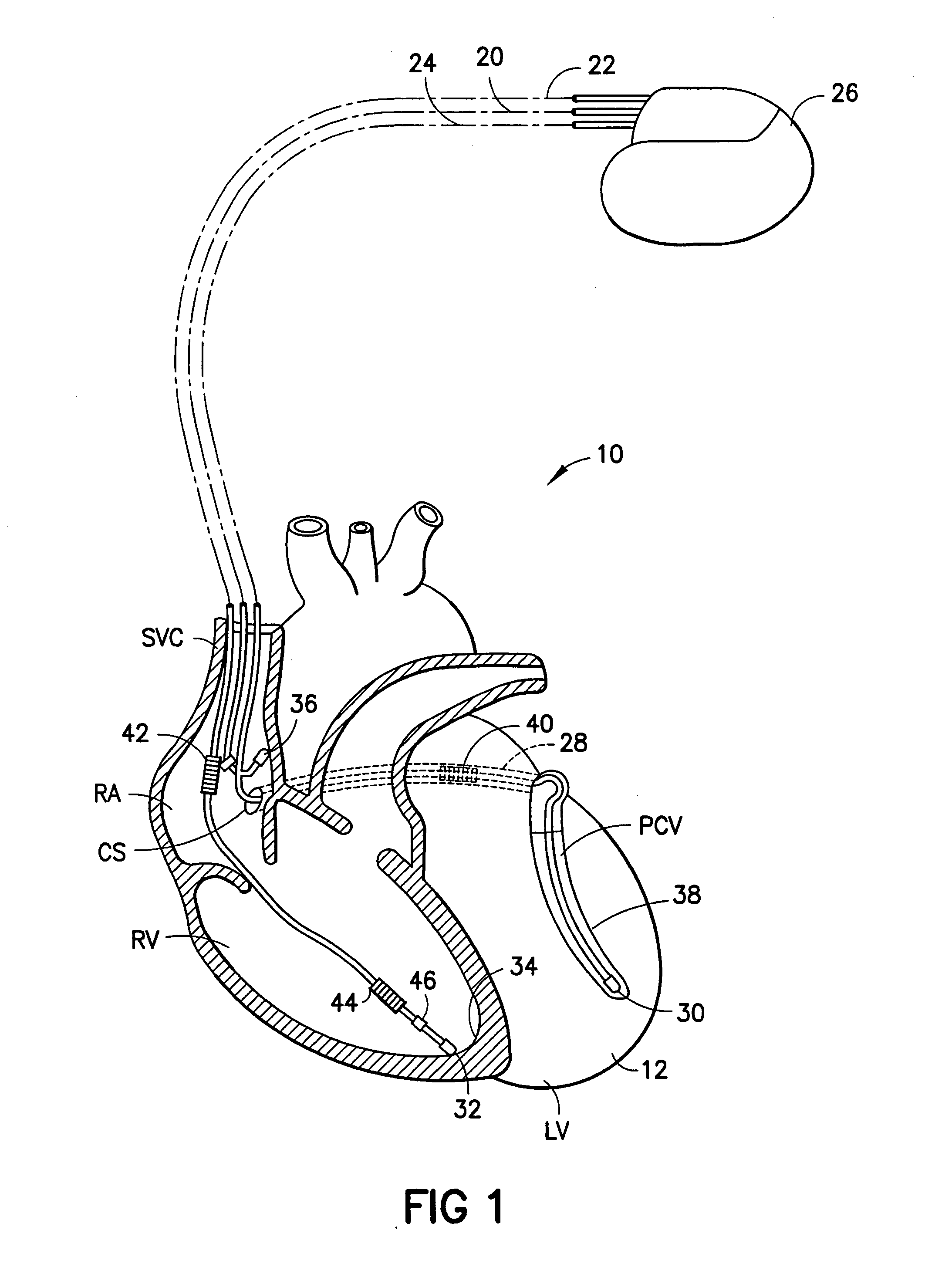 Lead body construction