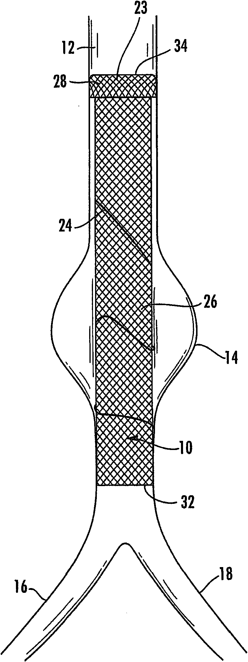 Stent graft for reinforcement of vascular abnormalities and associated method