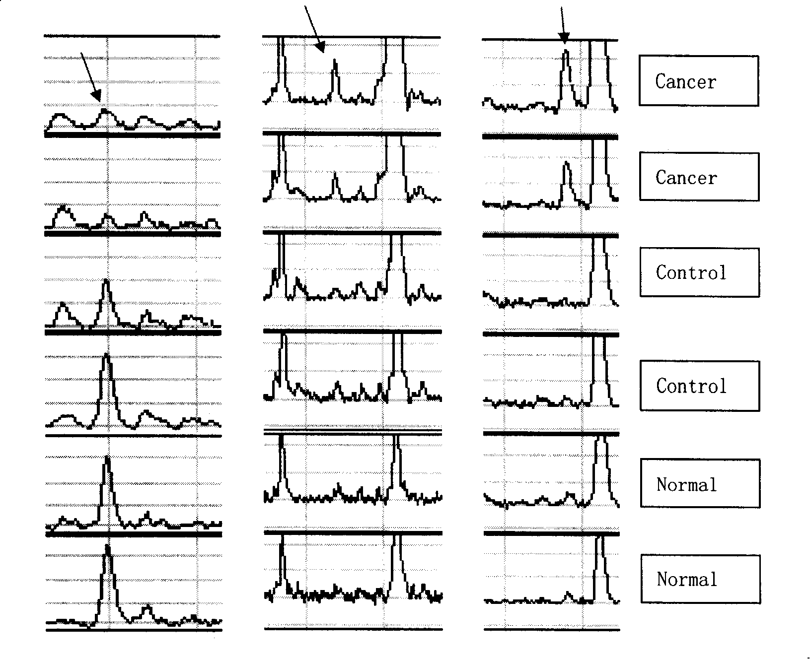 CEA negative colorectal cancer detection and prognosis judgement mass spectrum reagent kit and method