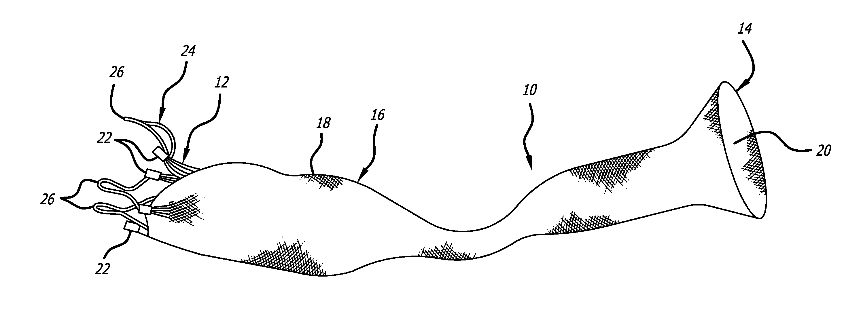 Stentless Support Structure