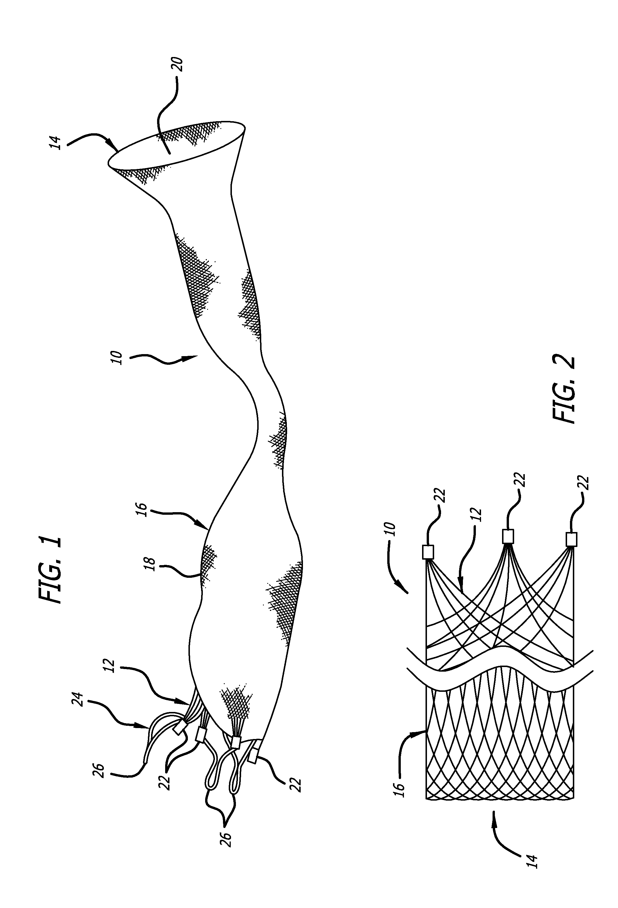 Stentless Support Structure